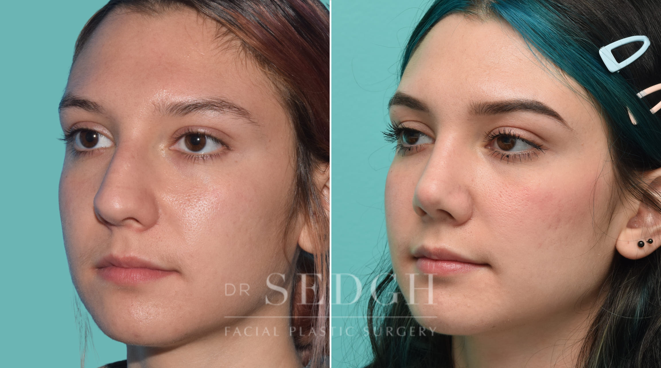 Rhinoplasty Before and After | Sedgh