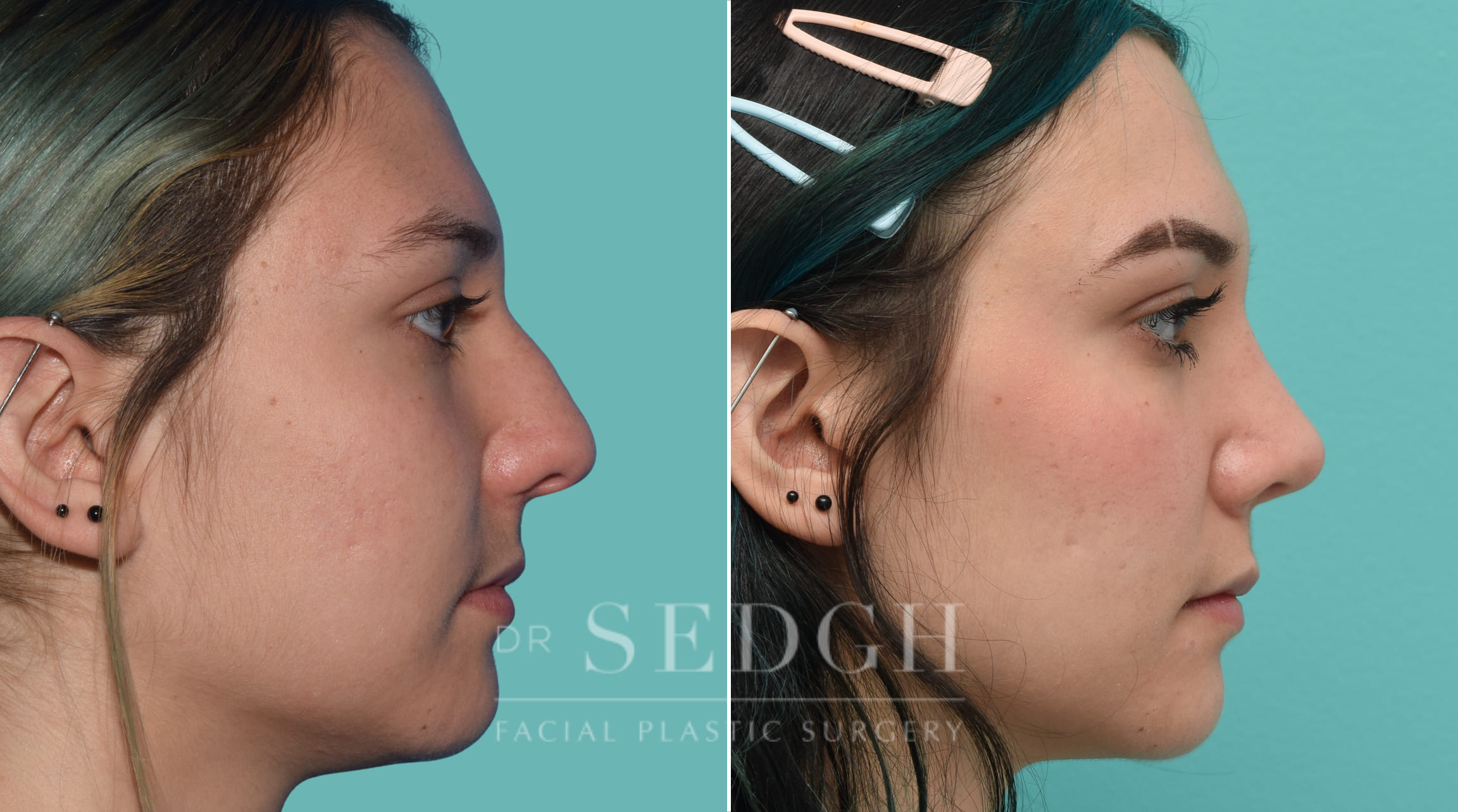 Rhinoplasty Before and After | Sedgh