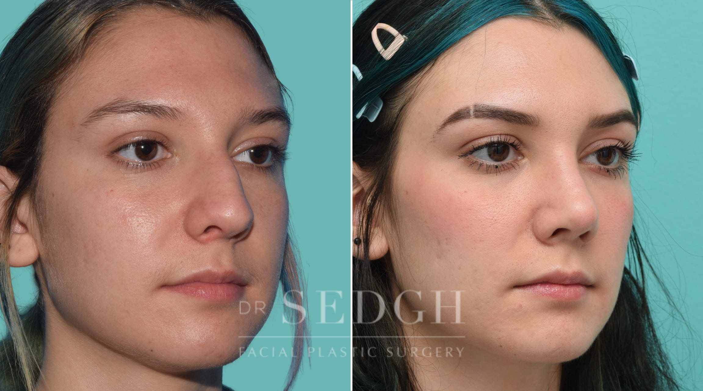 Rhinoplasty Before and After | Sedgh