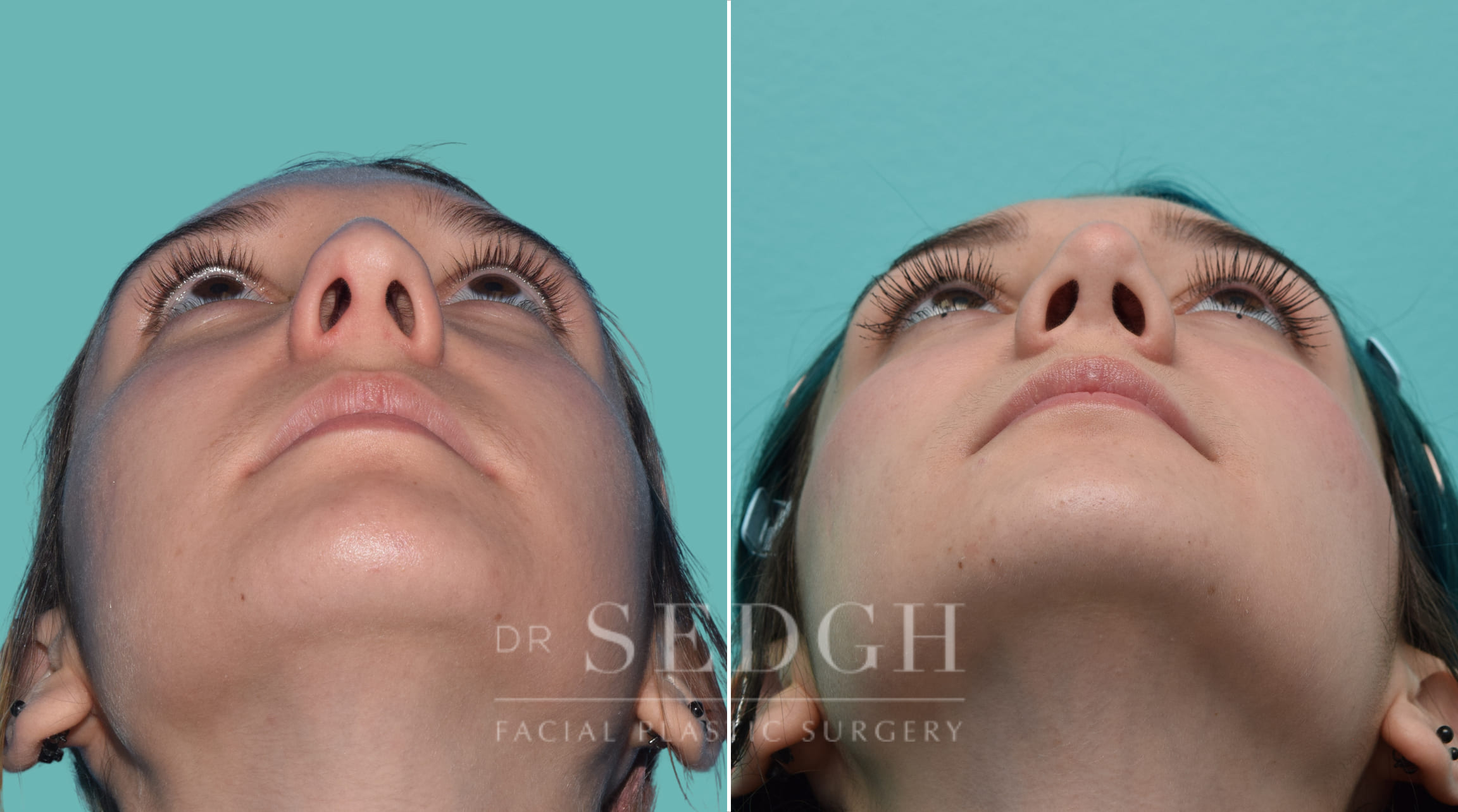 Rhinoplasty Before and After | Sedgh