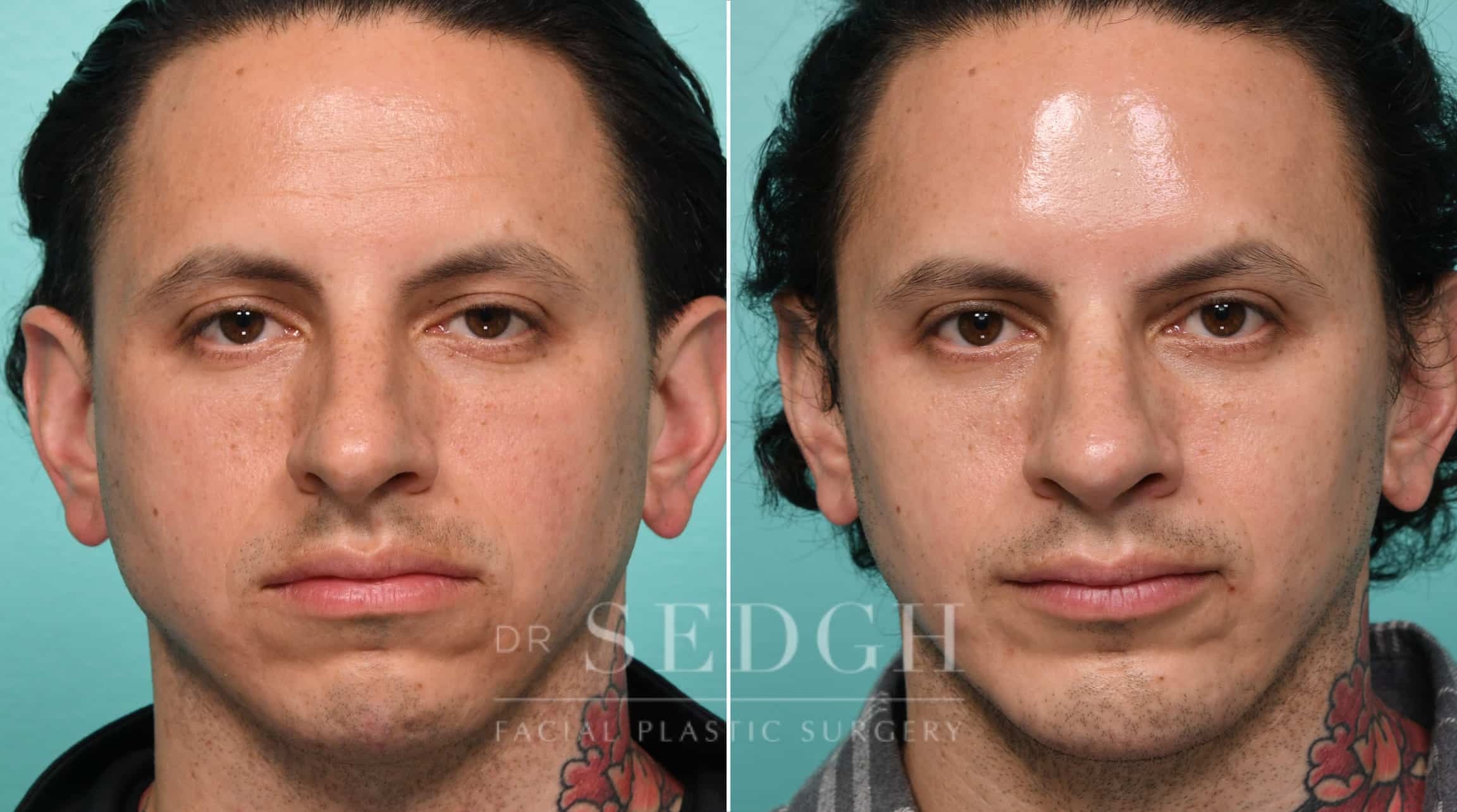 Male Patient Before and After Rhinoplasty, Chin Augmentation | Sedgh