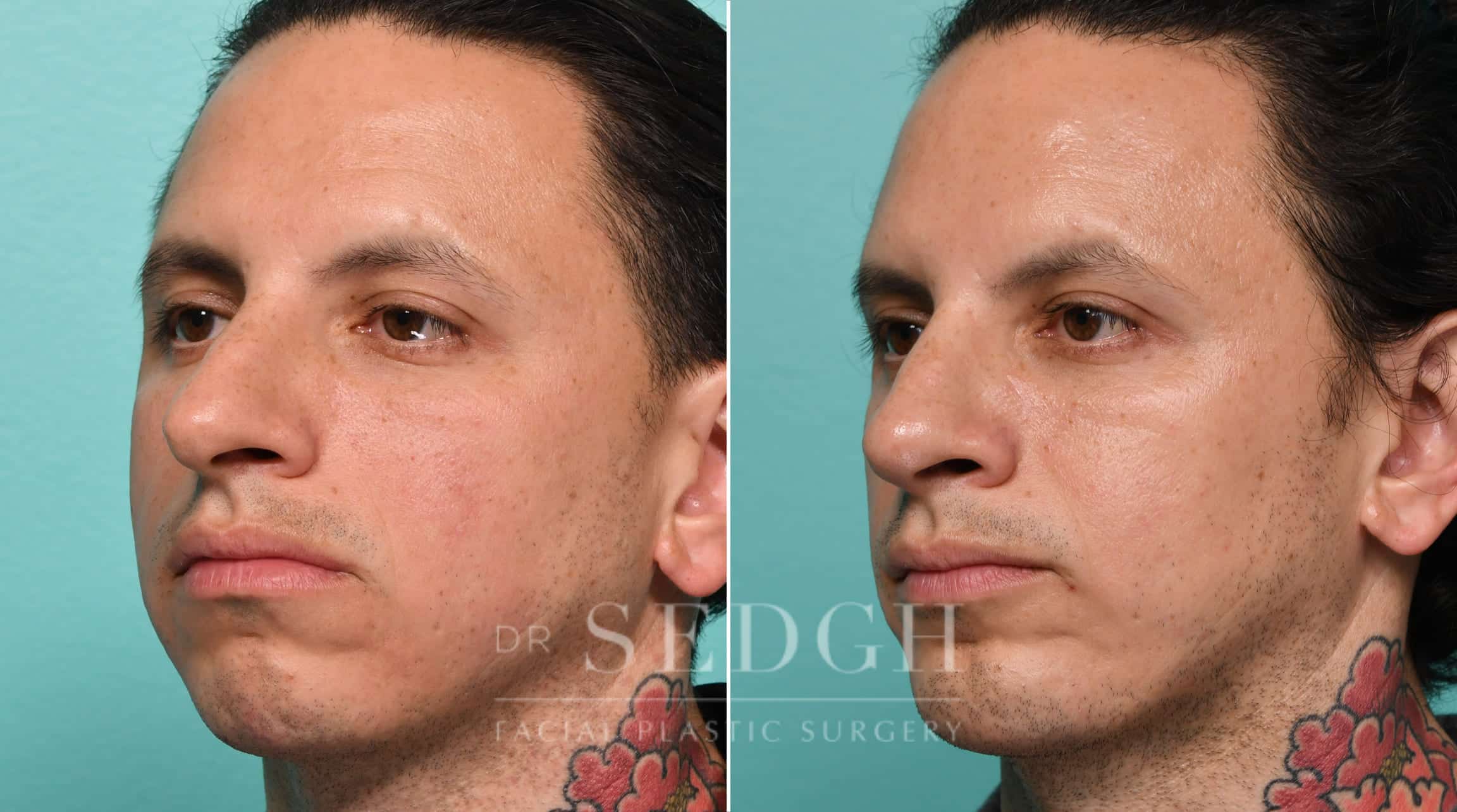 Male Patient Before and After Rhinoplasty, Chin Augmentation | Sedgh