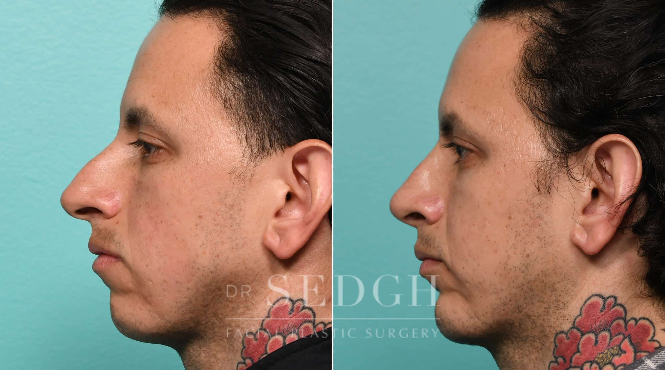 Male Patient Before and After Rhinoplasty, Chin Augmentation | Sedgh