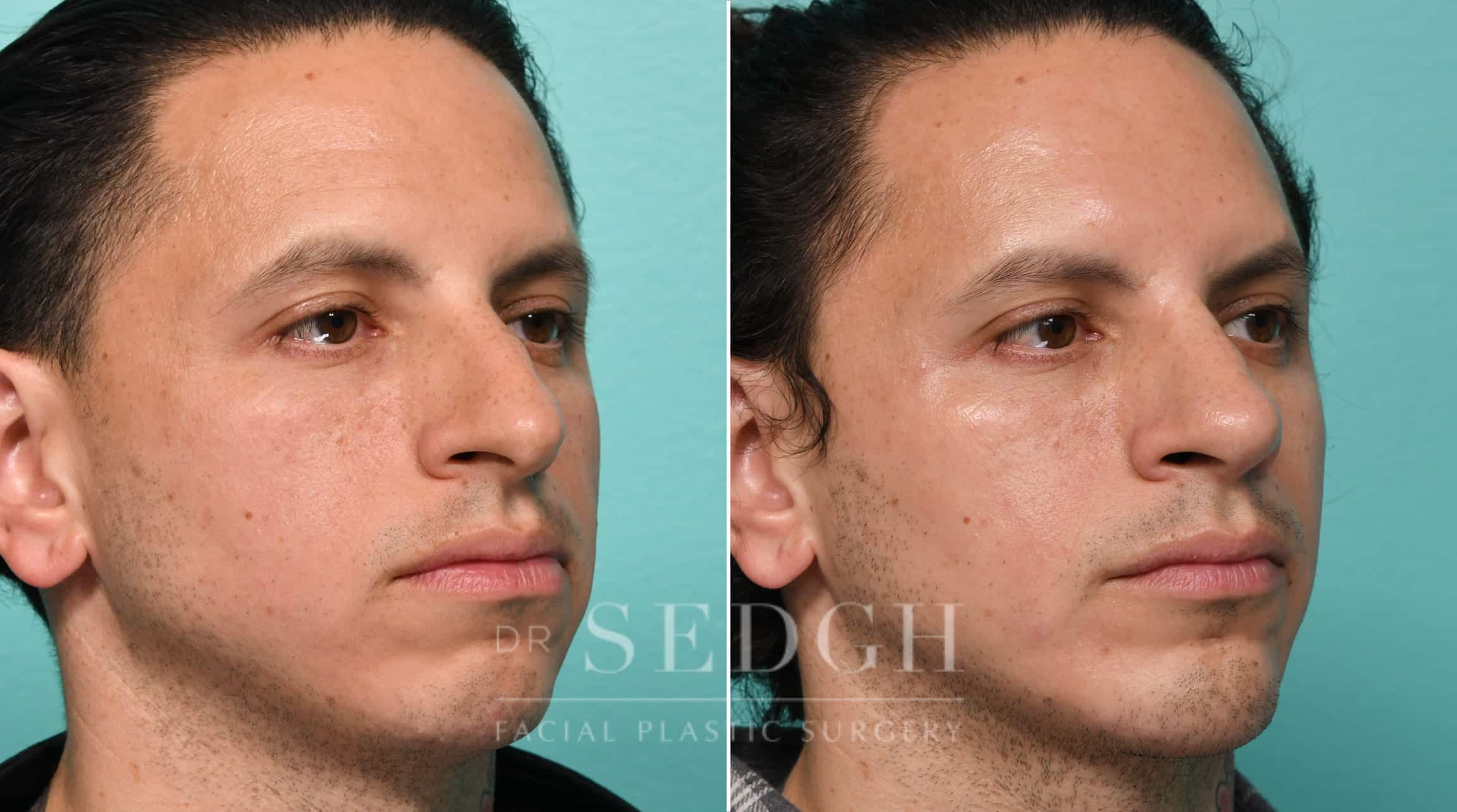 Male Patient Before and After Rhinoplasty, Chin Augmentation | Sedgh