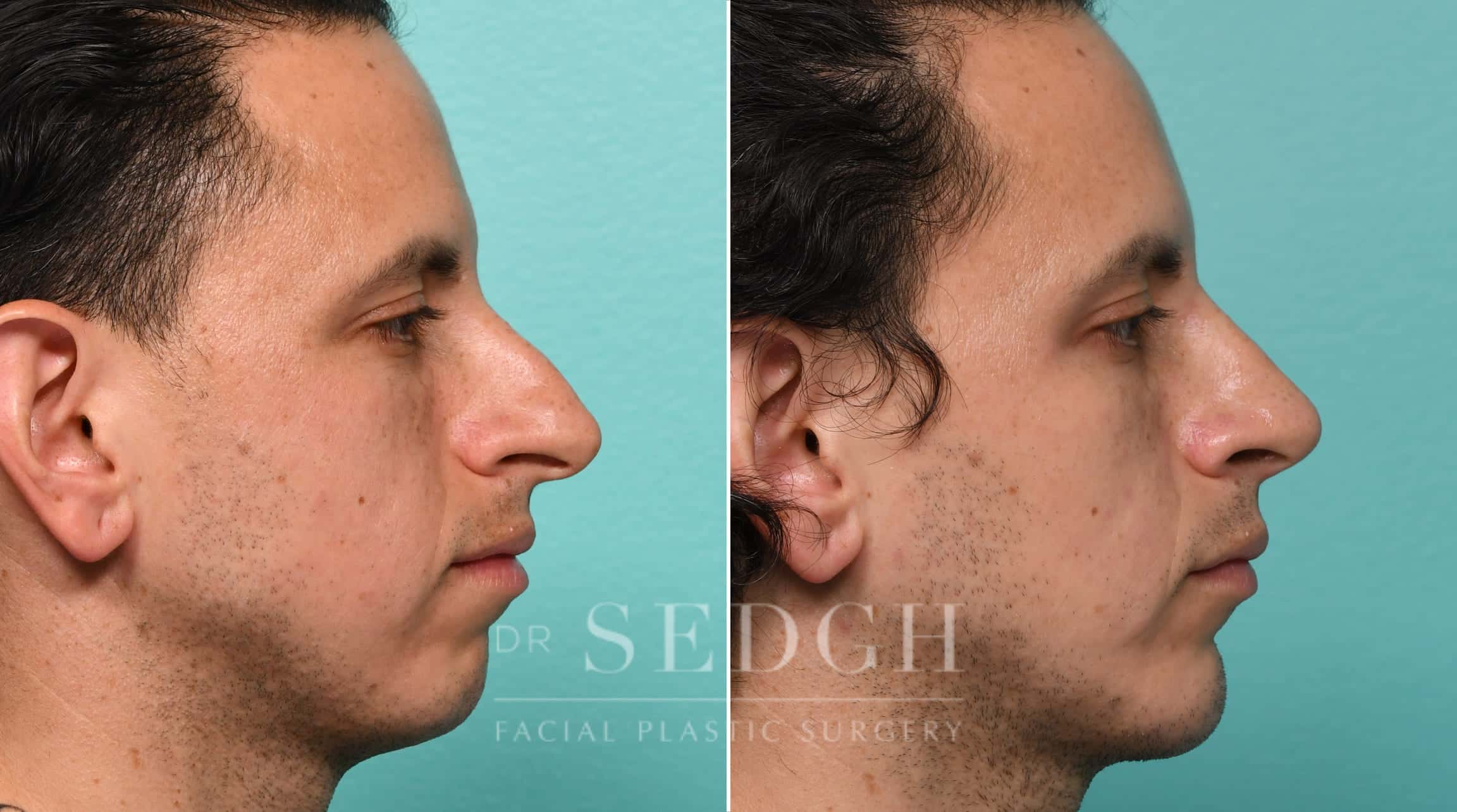 Male Patient Before and After Rhinoplasty, Chin Augmentation | Sedgh