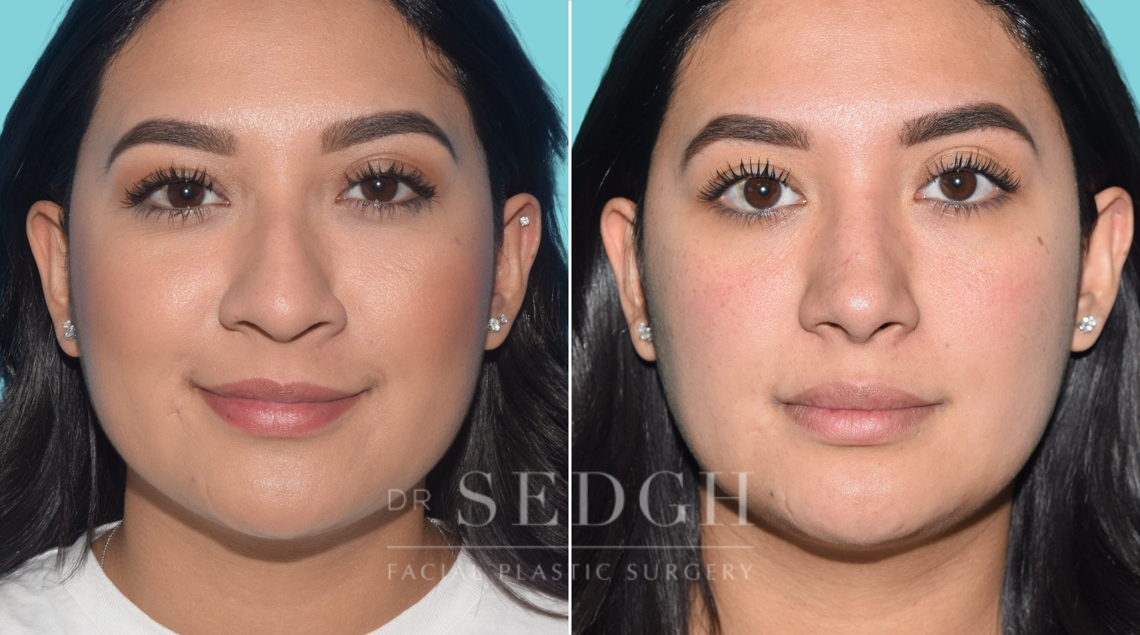 female patient before and after rhinoplasty procedure