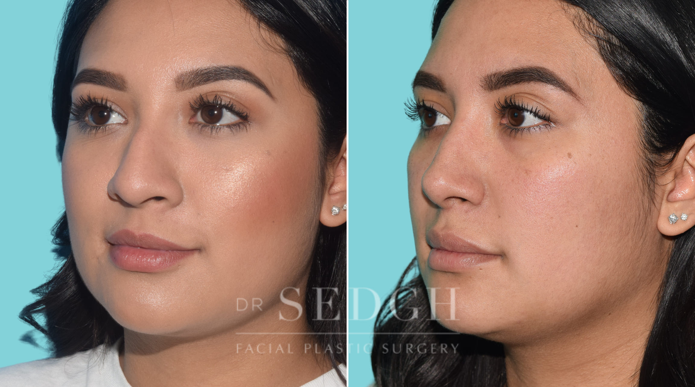 female patient before and after rhinoplasty procedure