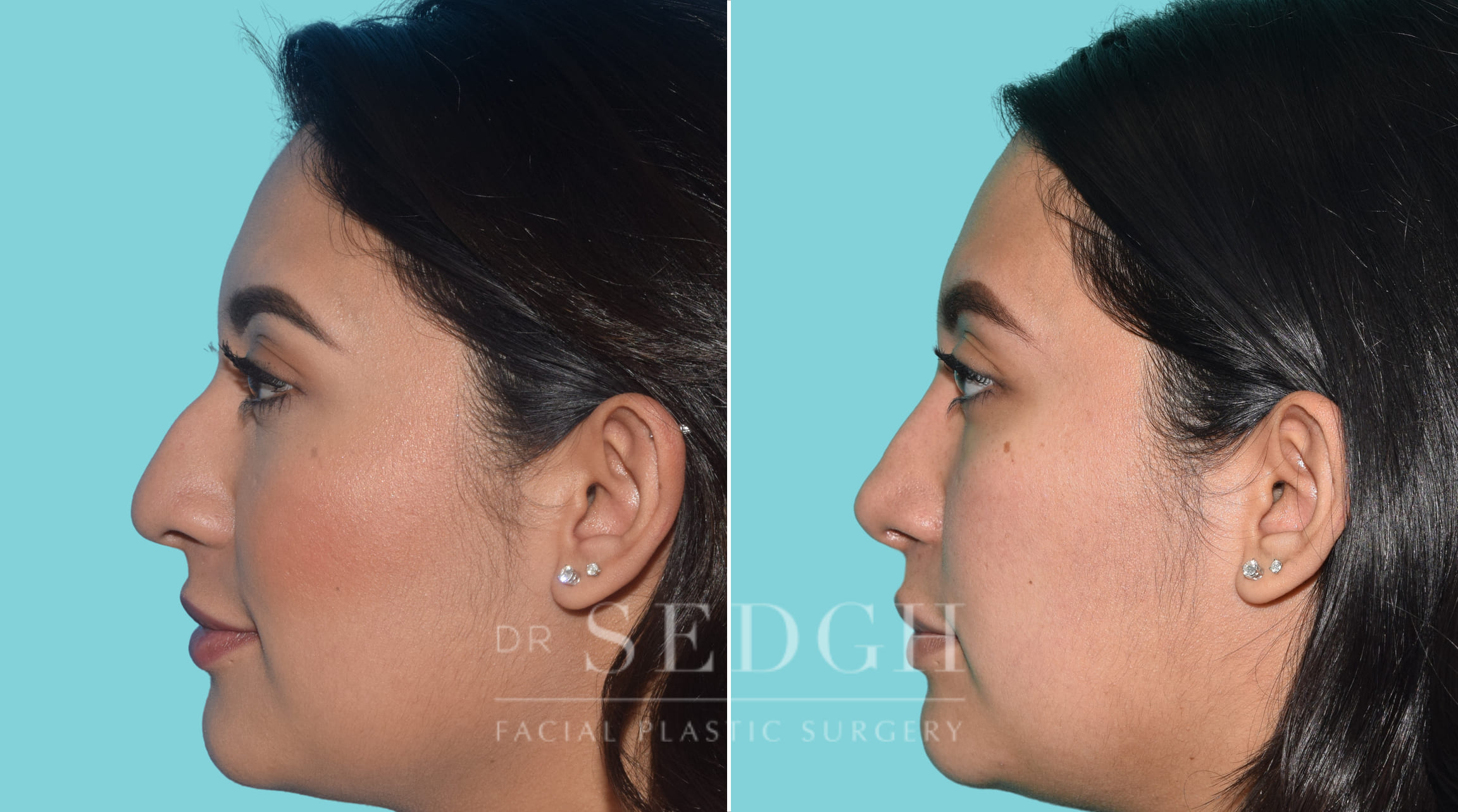 female patient before and after rhinoplasty procedure