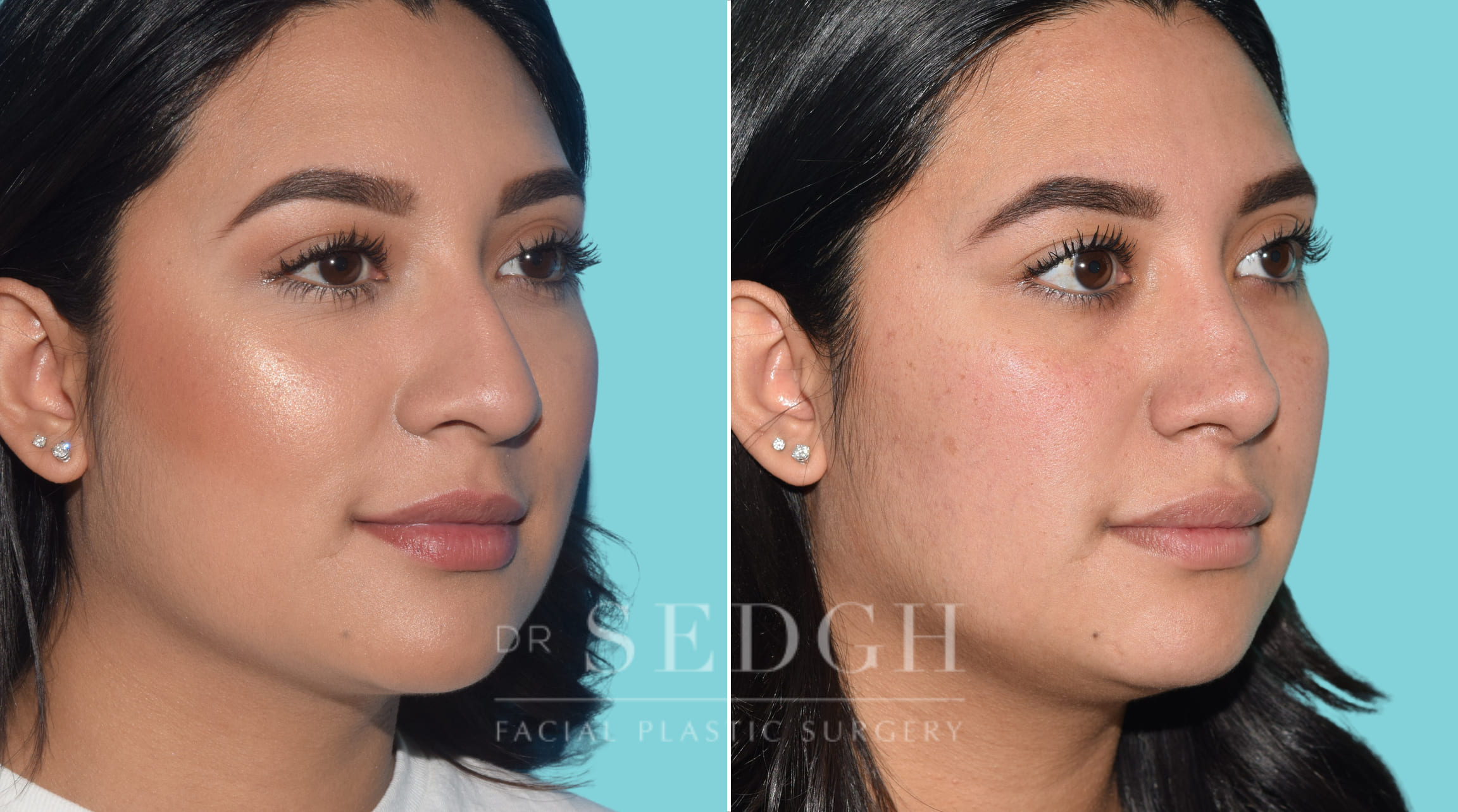 female patient before and after rhinoplasty procedure