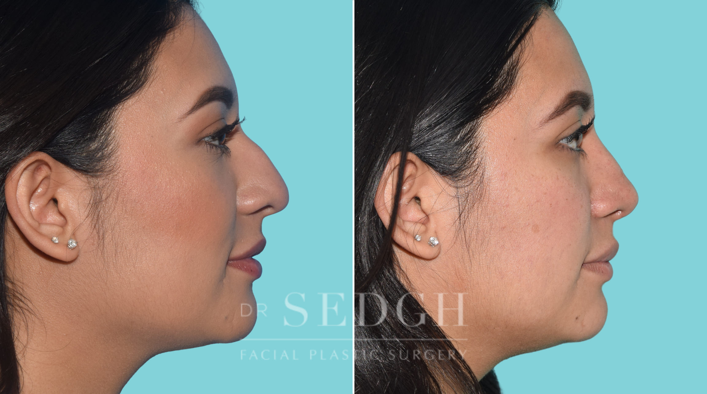 female patient before and after rhinoplasty procedure