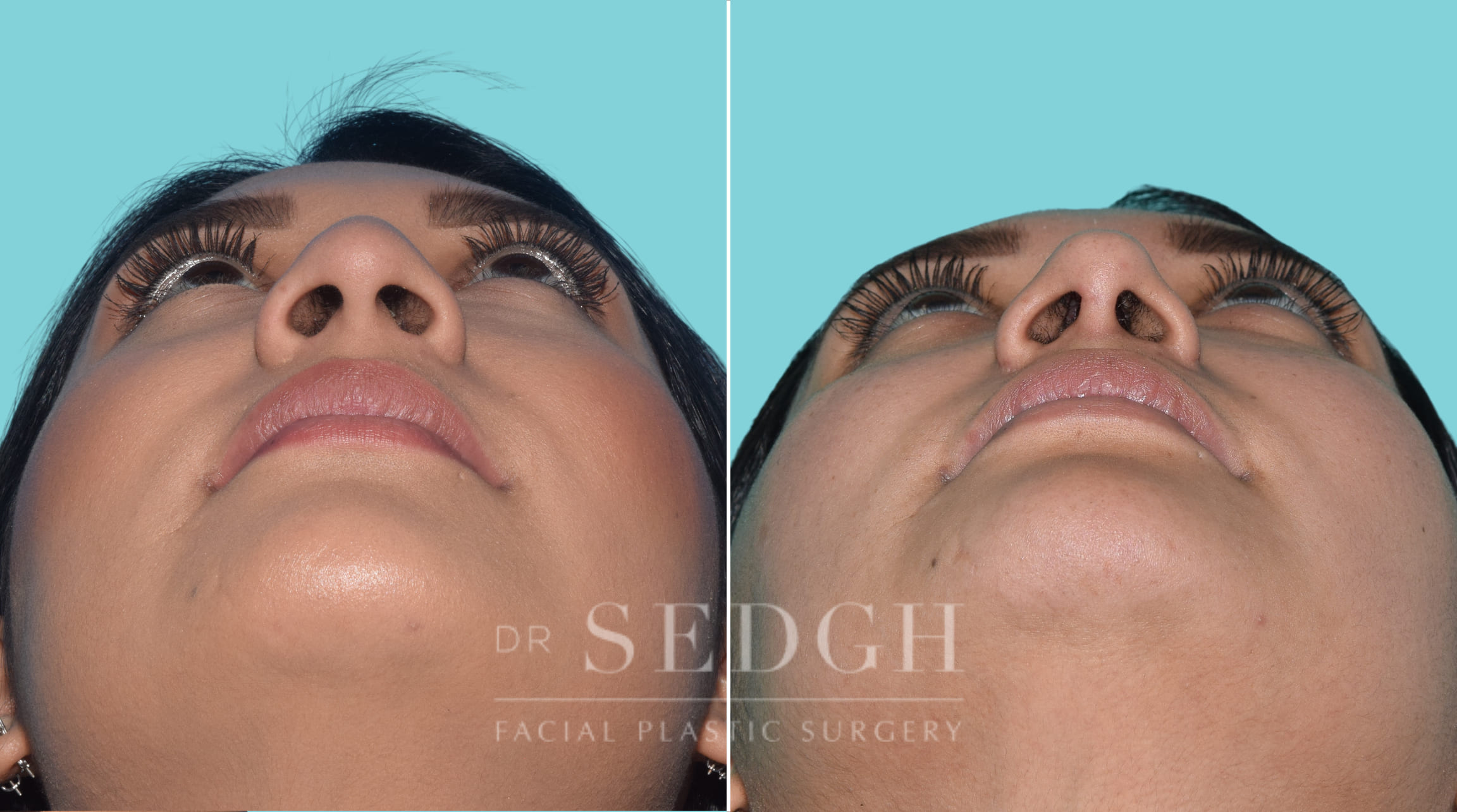 female patient before and after rhinoplasty procedure