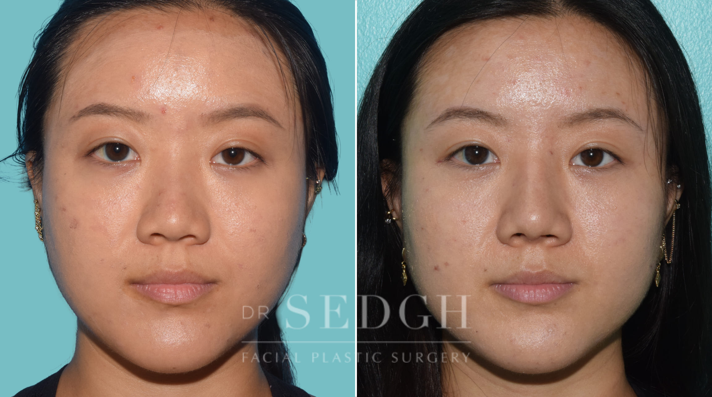 female patient before and after rhinoplasty procedure | Sedgh