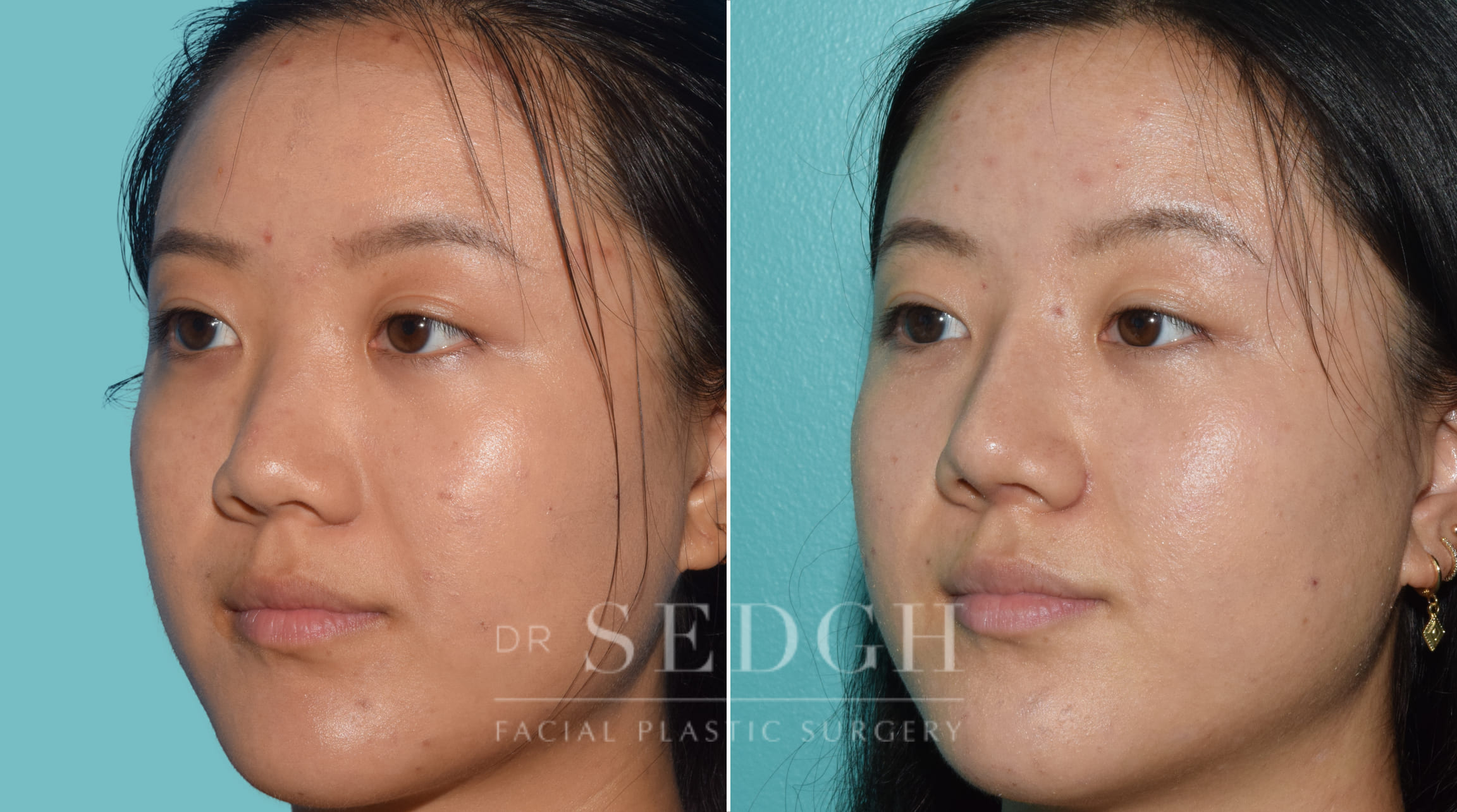 female patient before and after rhinoplasty procedure | Sedgh