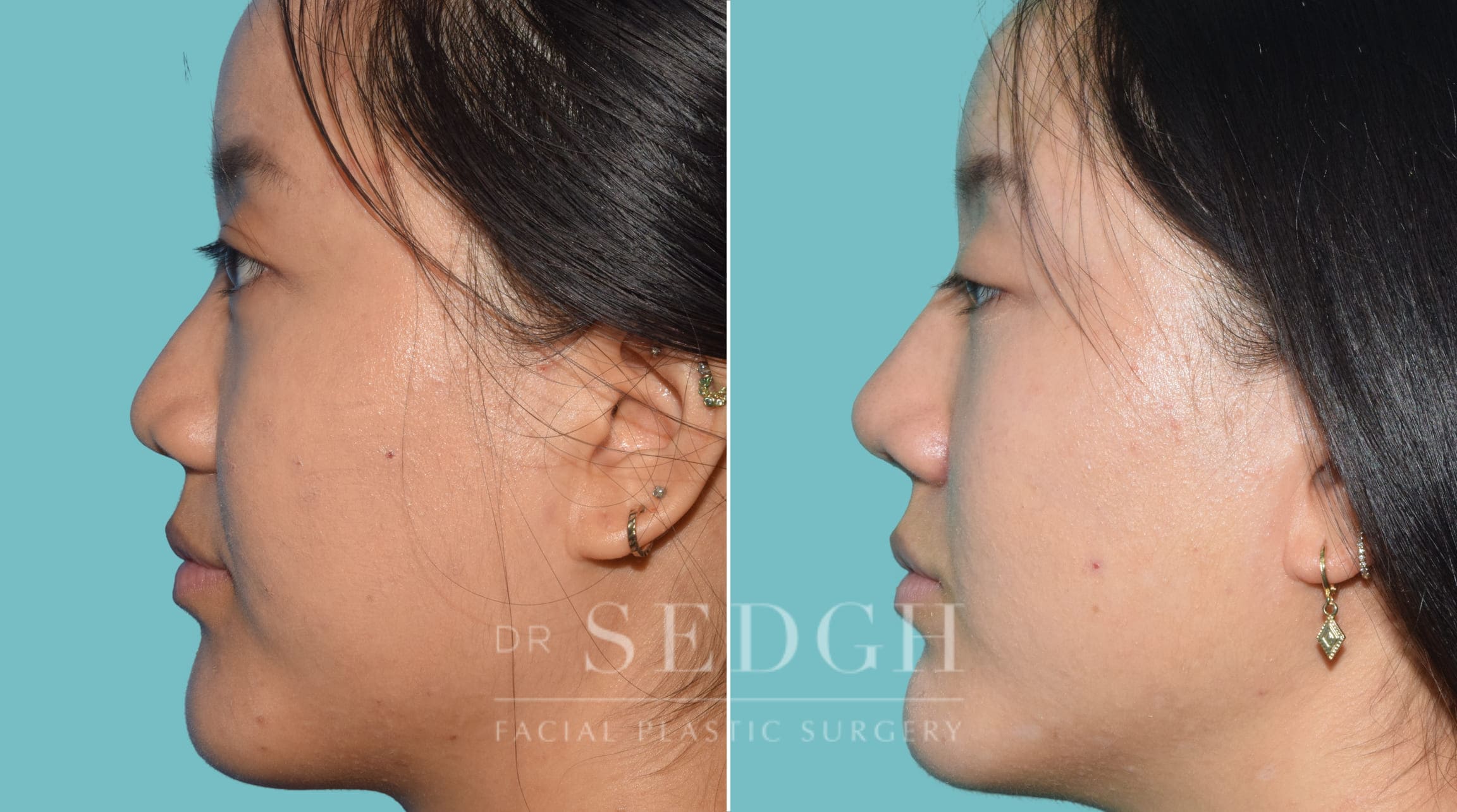 female patient before and after rhinoplasty procedure | Sedgh