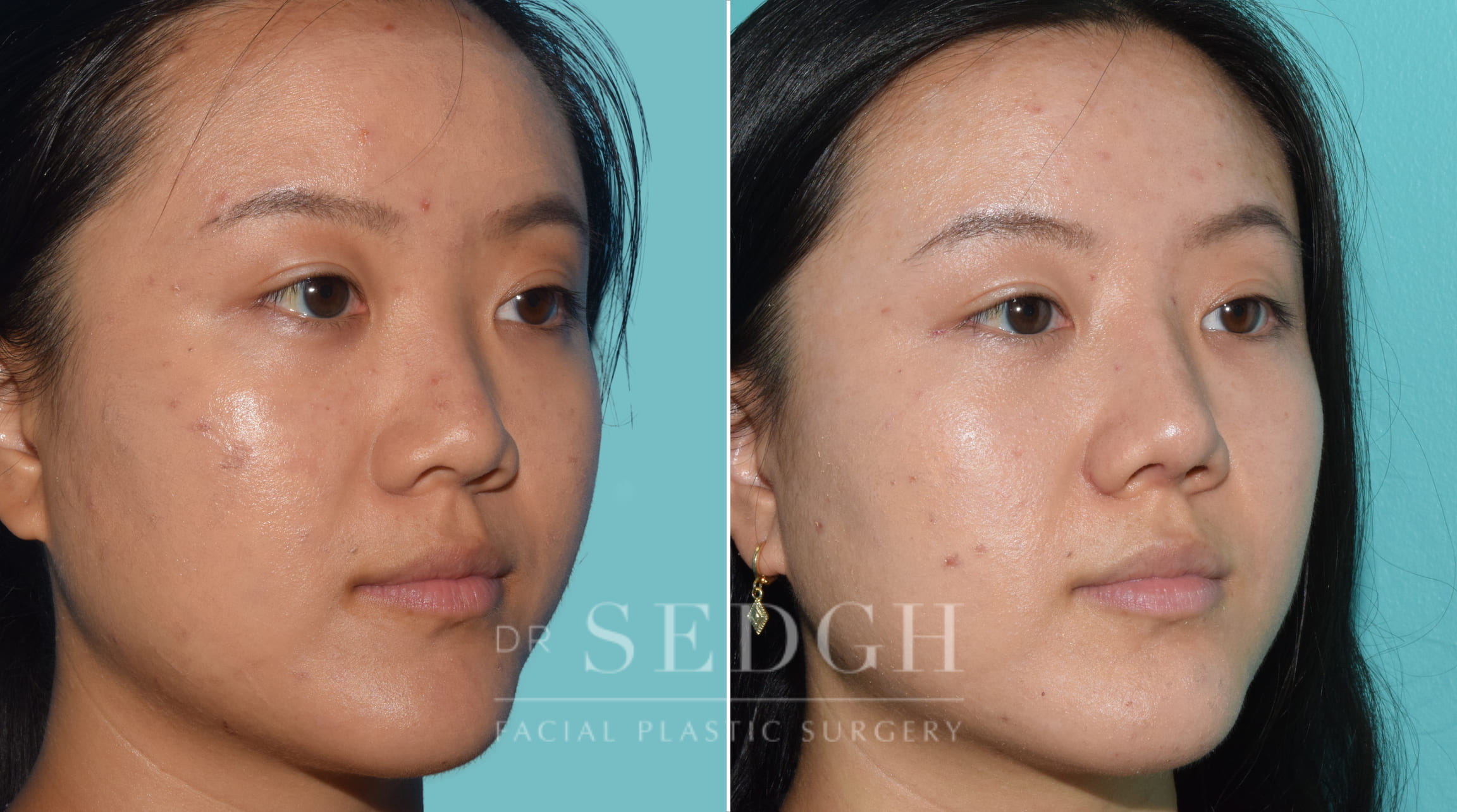 female patient before and after rhinoplasty procedure | Sedgh