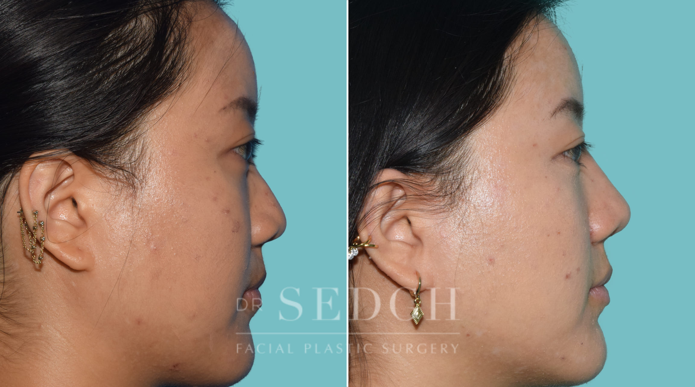 female patient before and after rhinoplasty procedure | Sedgh