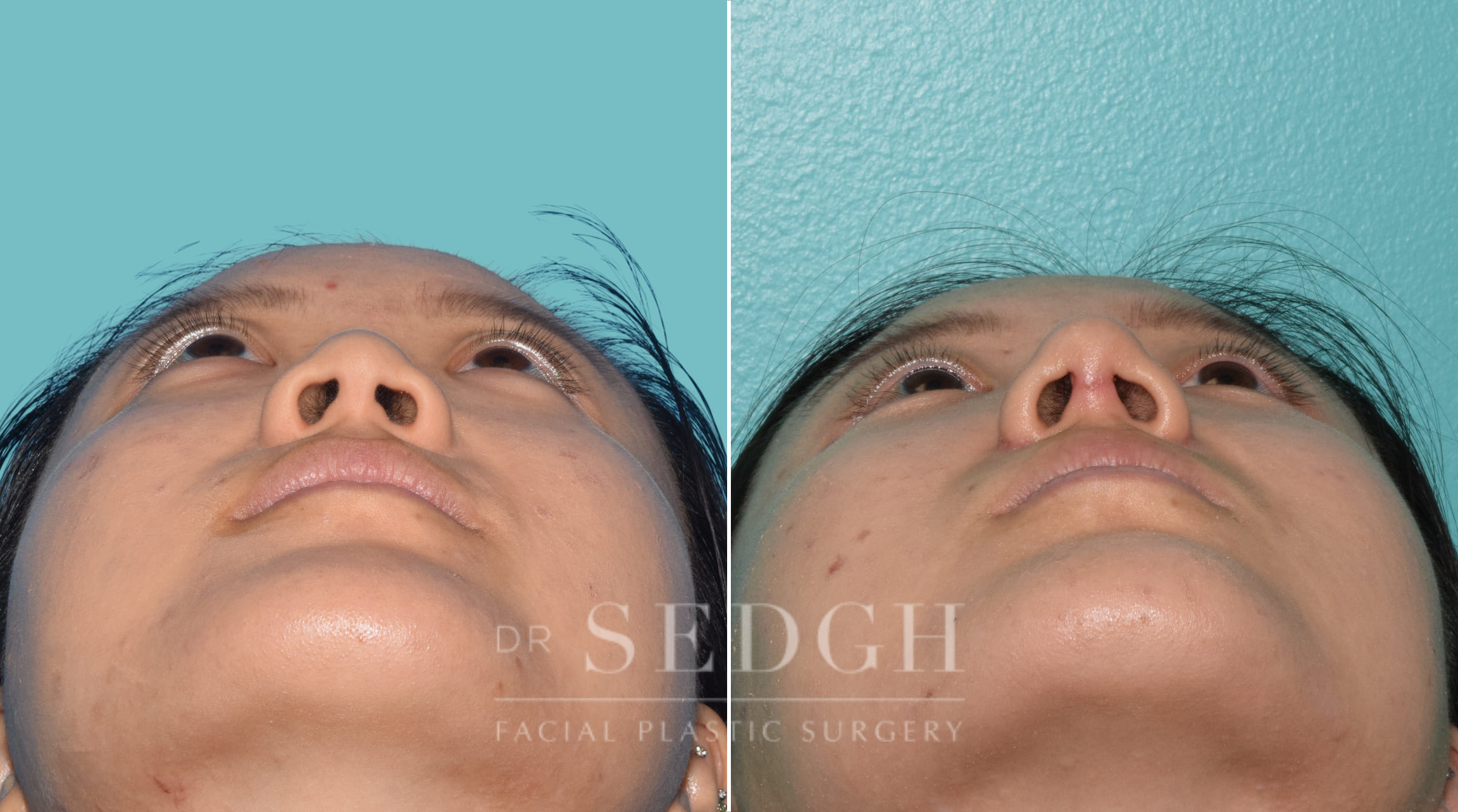 female patient before and after rhinoplasty procedure | Sedgh