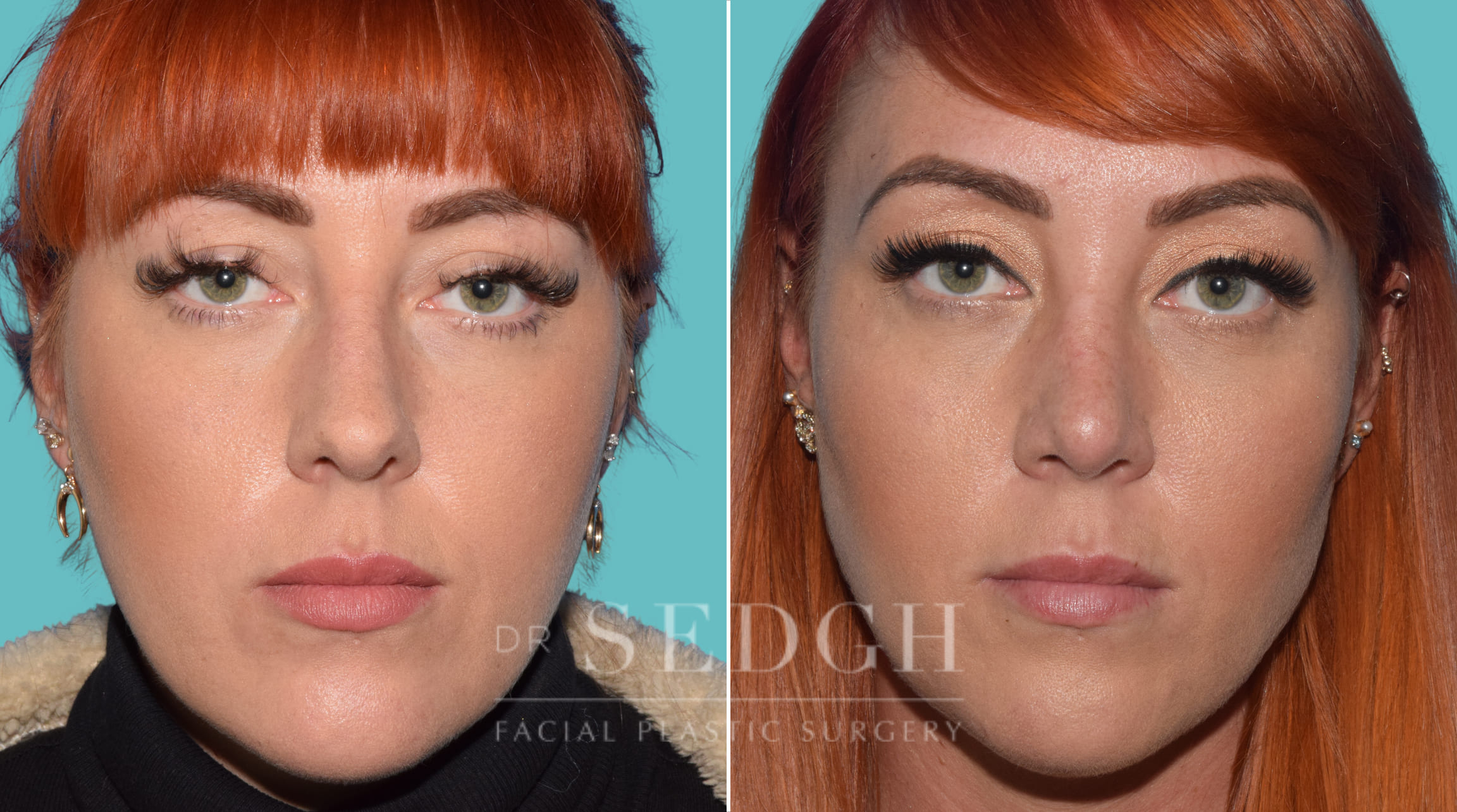 Female Rhinoplasty Before and After | Sedgh