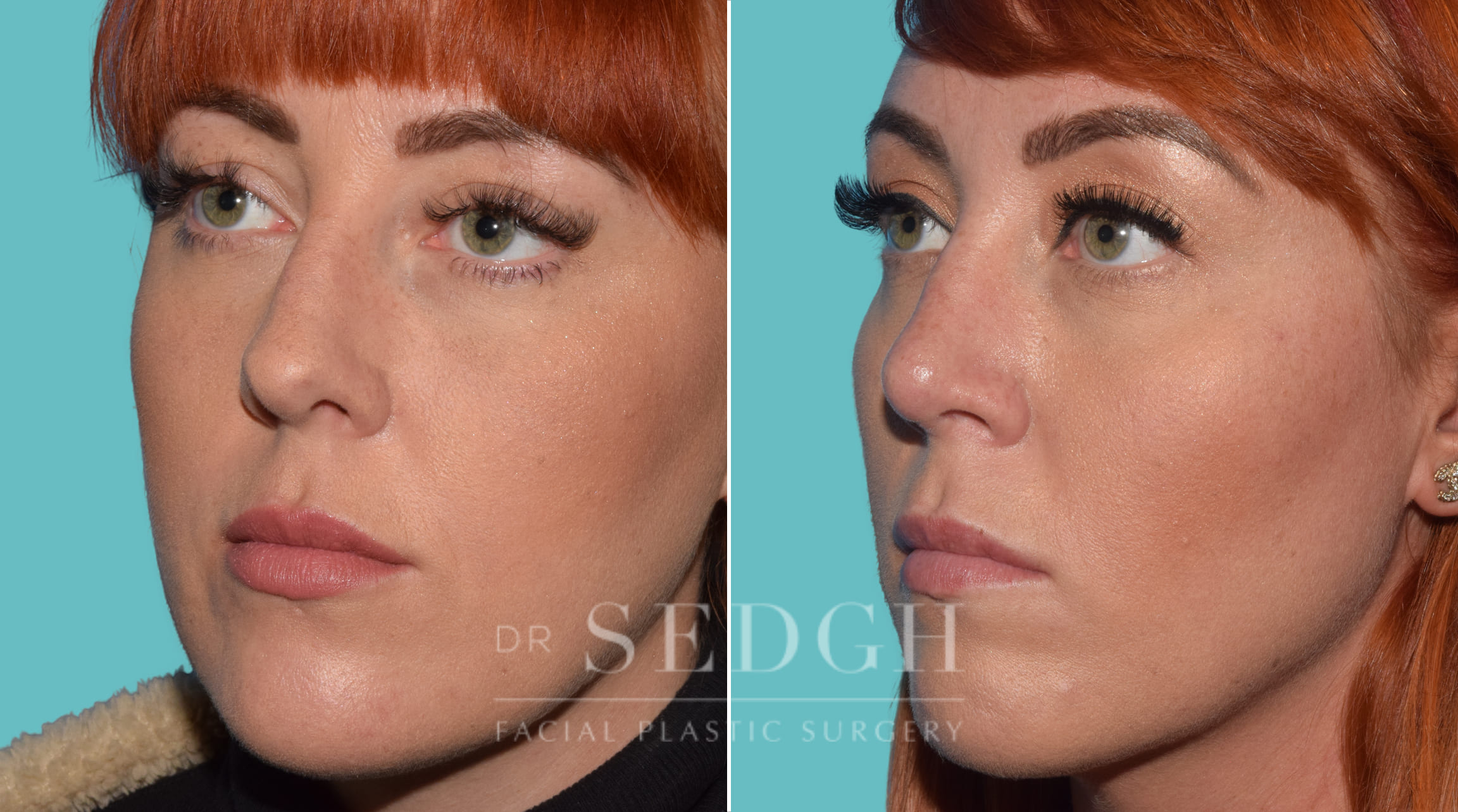 Female Rhinoplasty Before and After | Sedgh