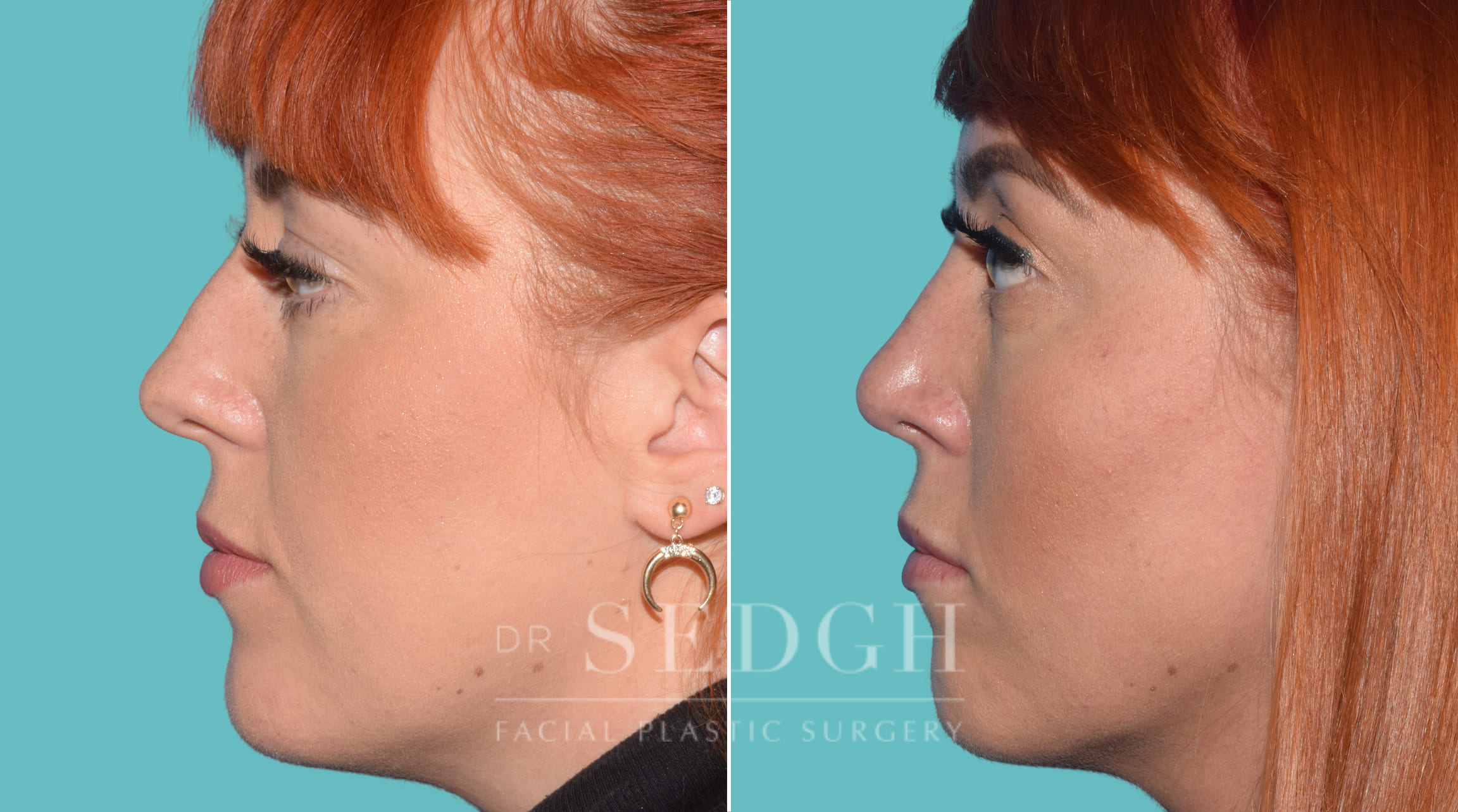 Female Rhinoplasty Before and After | Sedgh