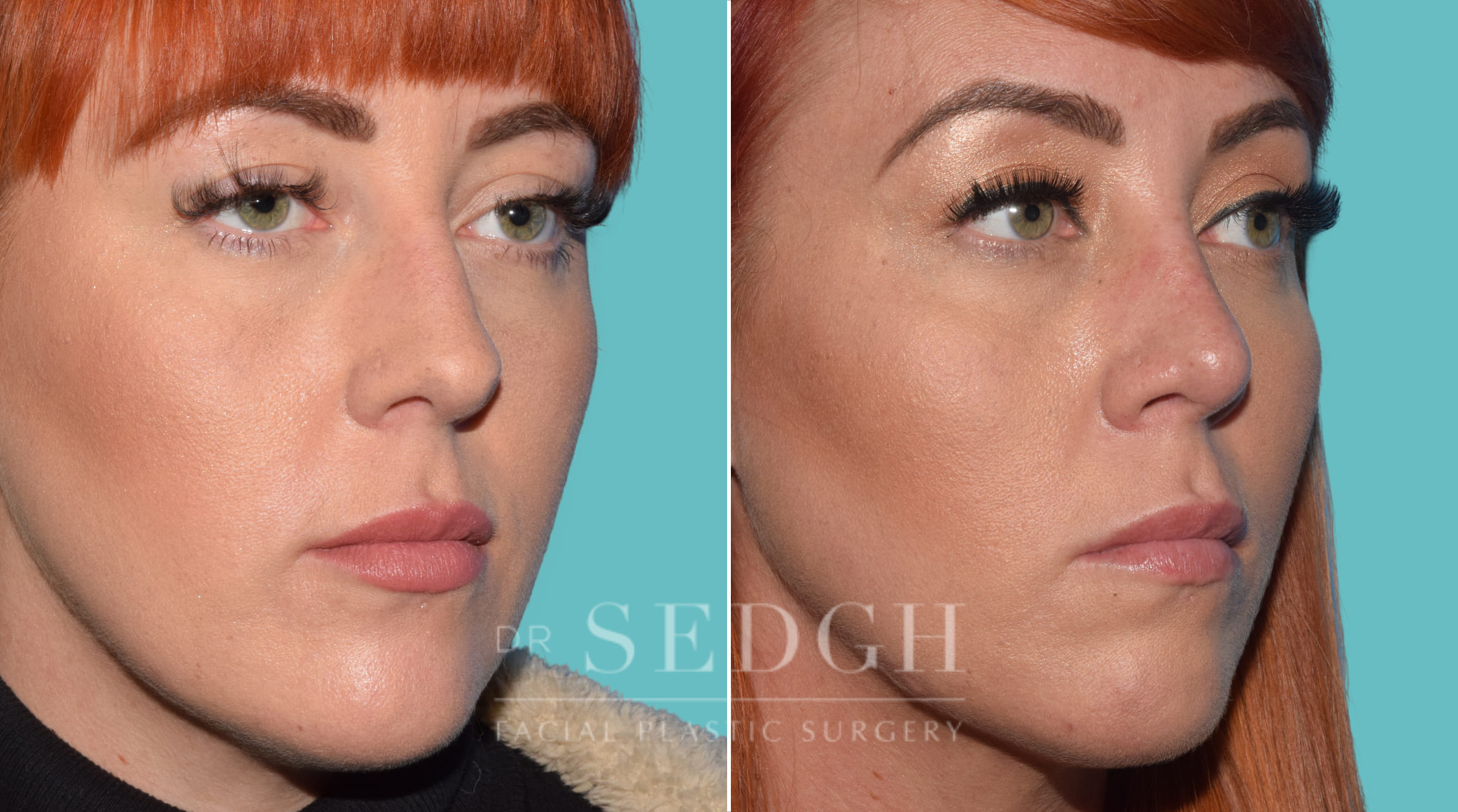 Female Rhinoplasty Before and After | Sedgh