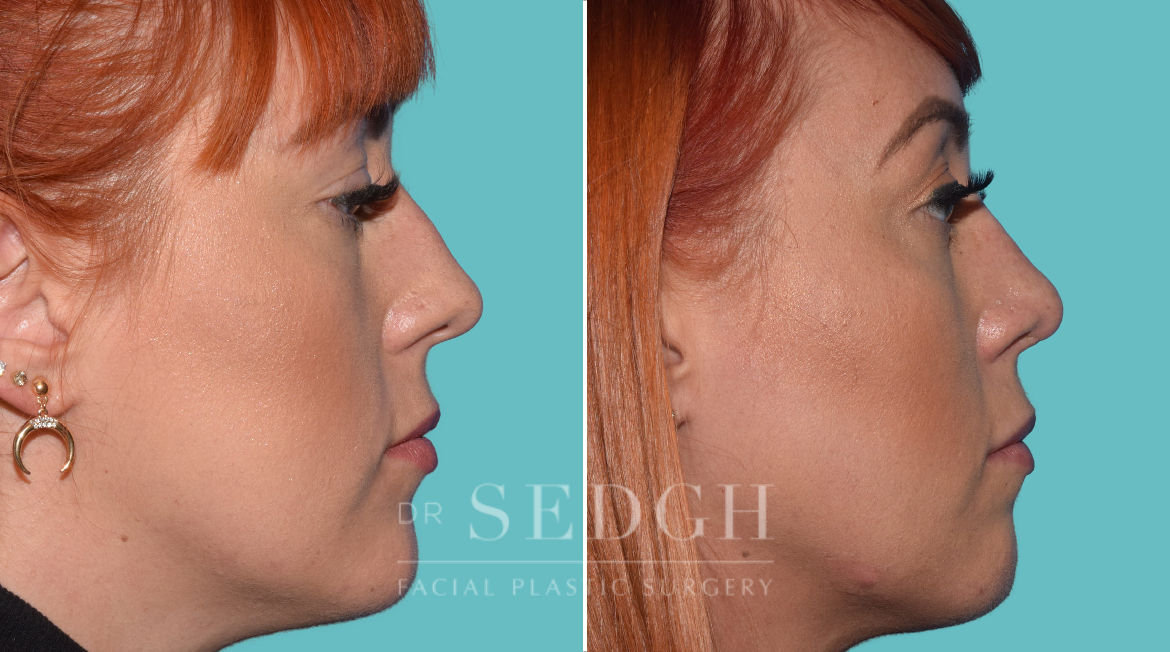 Female Rhinoplasty Before and After | Sedgh