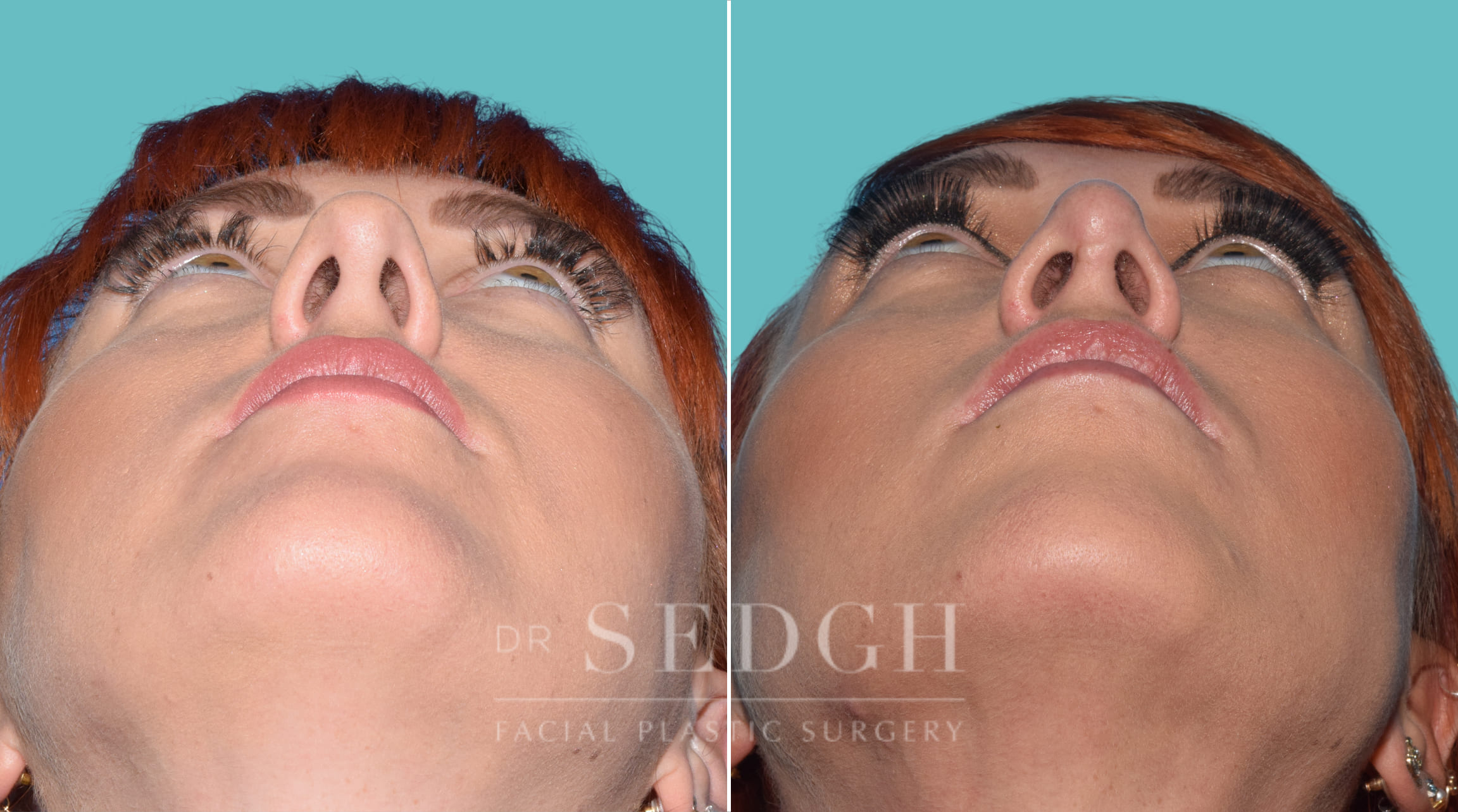 Female Rhinoplasty Before and After | Sedgh