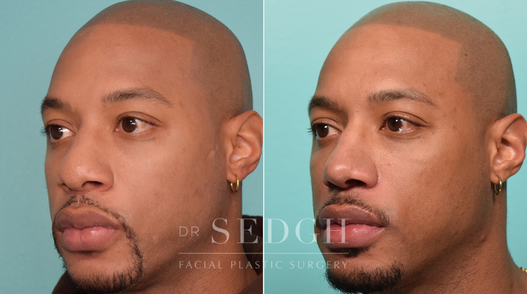 good rhinoplasty before and after