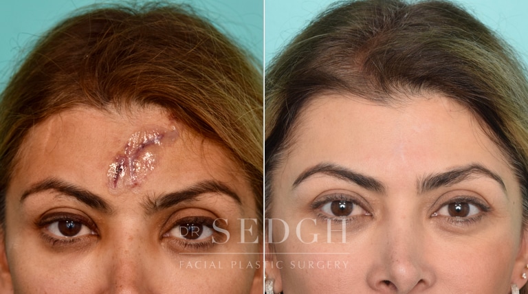 Scar Revision Before And After Photos Dr Sedgh 4136