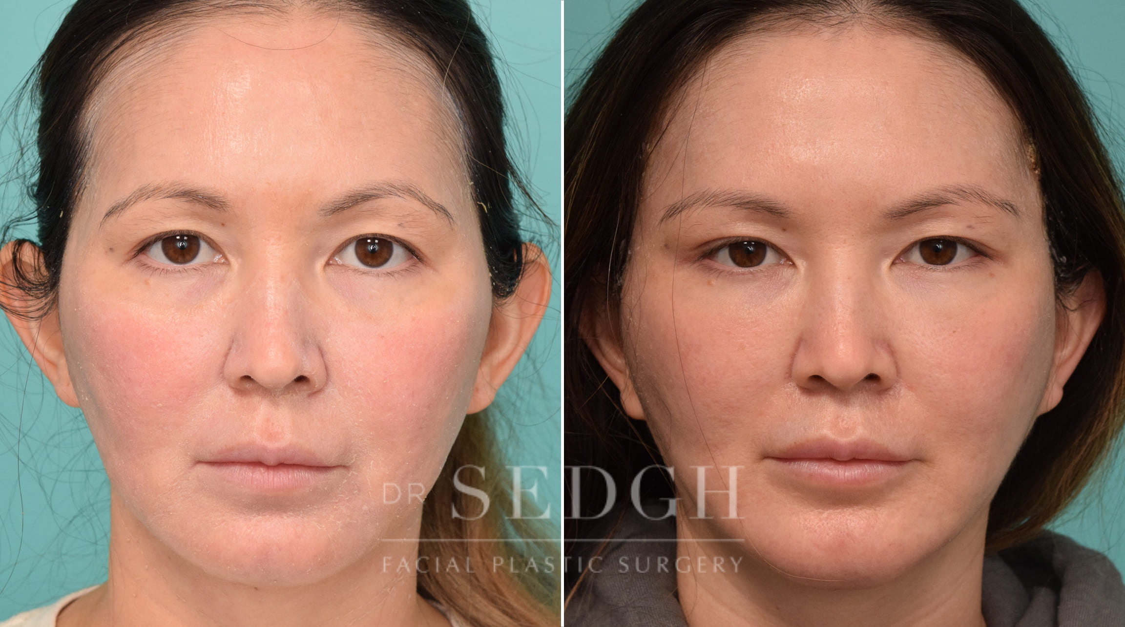 Female Patient Before and After Facelift, Brow Lift, Chin Augmentation | Sedgh