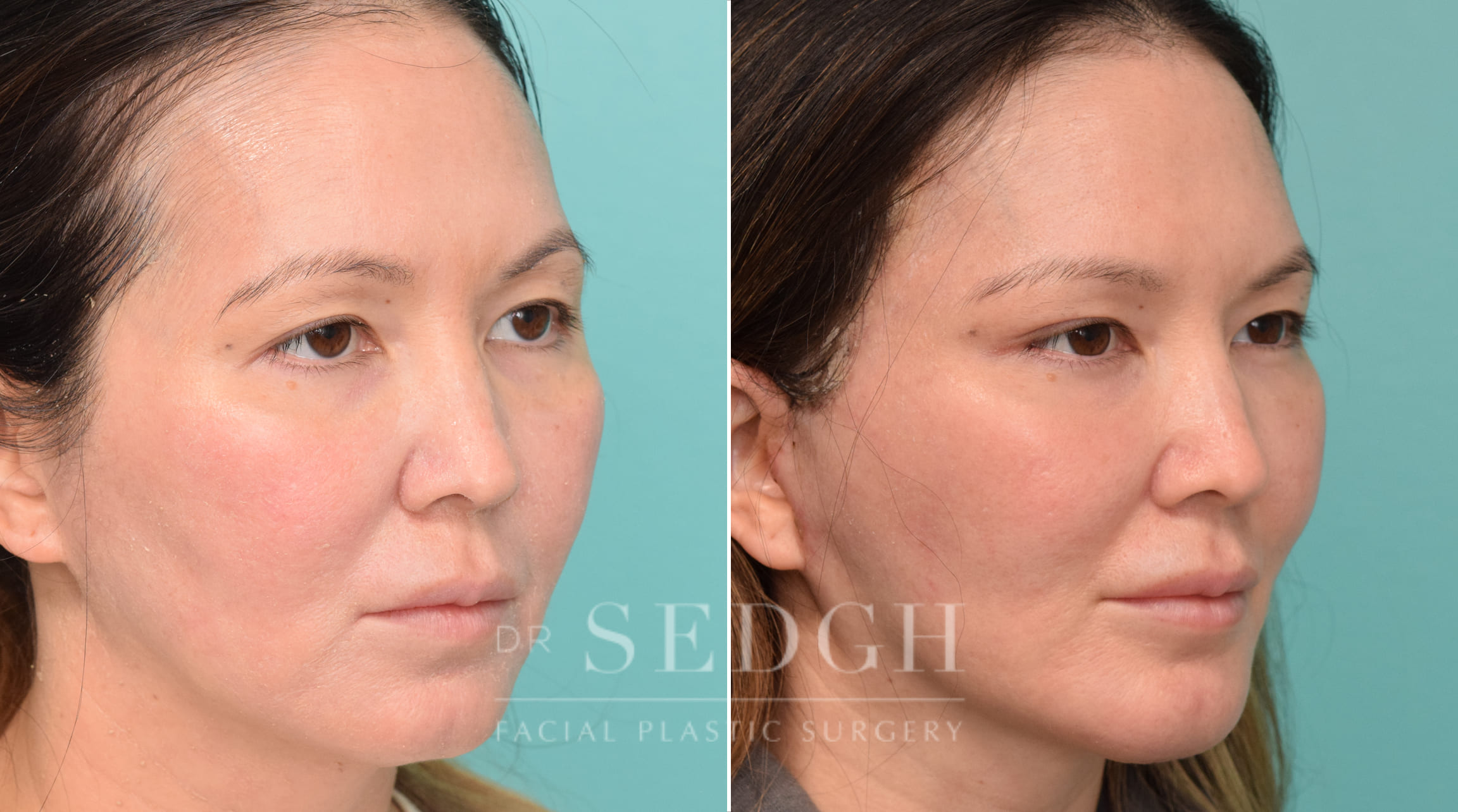 Female Patient Before and After Facelift, Brow Lift, Chin Augmentation | Sedgh