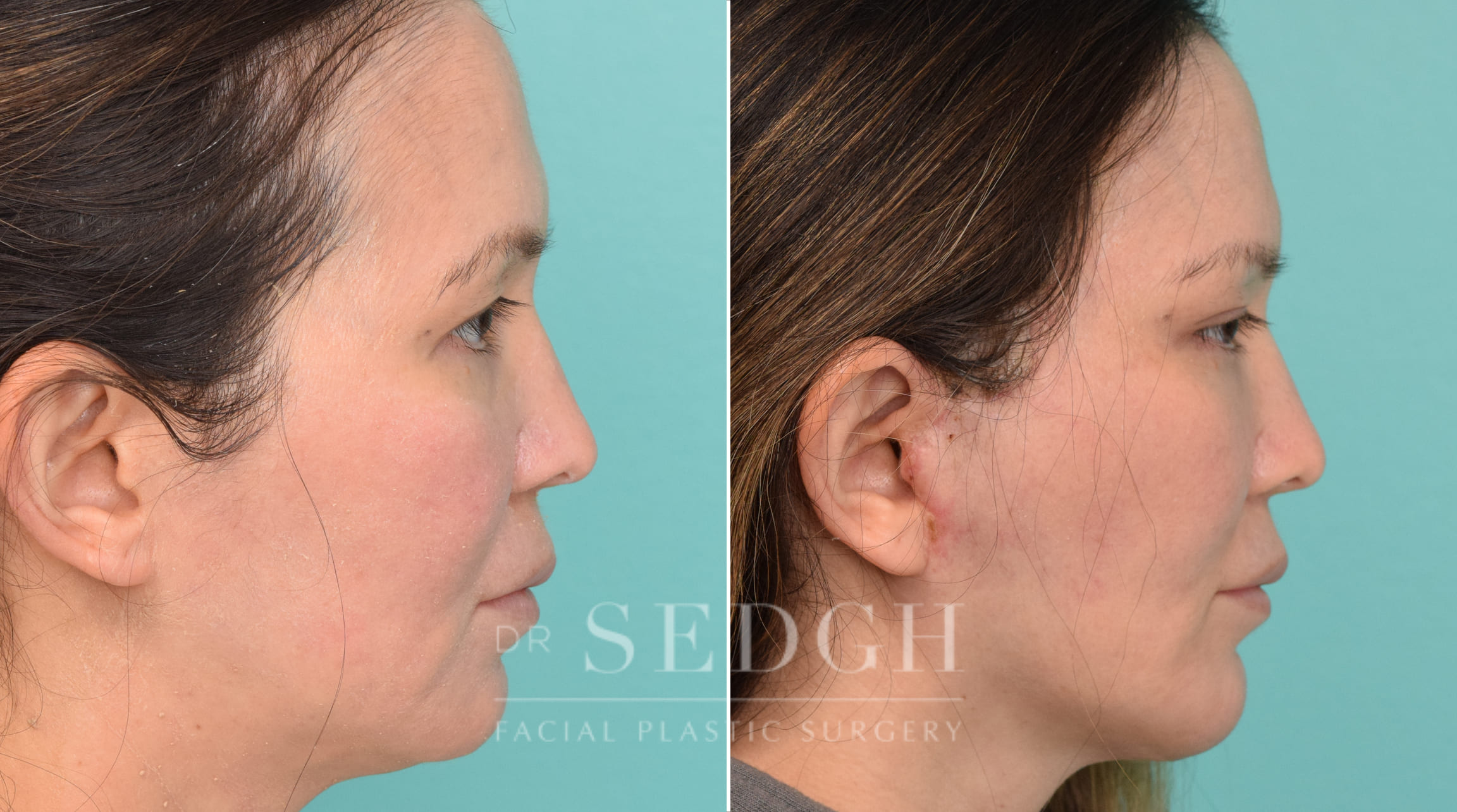 Female Patient Before and After Facelift, Brow Lift, Chin Augmentation | Sedgh