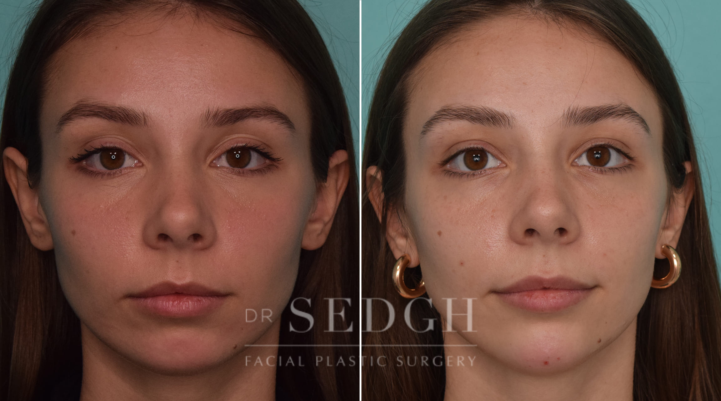 Patient Before and After Chin Filler | Sedgh