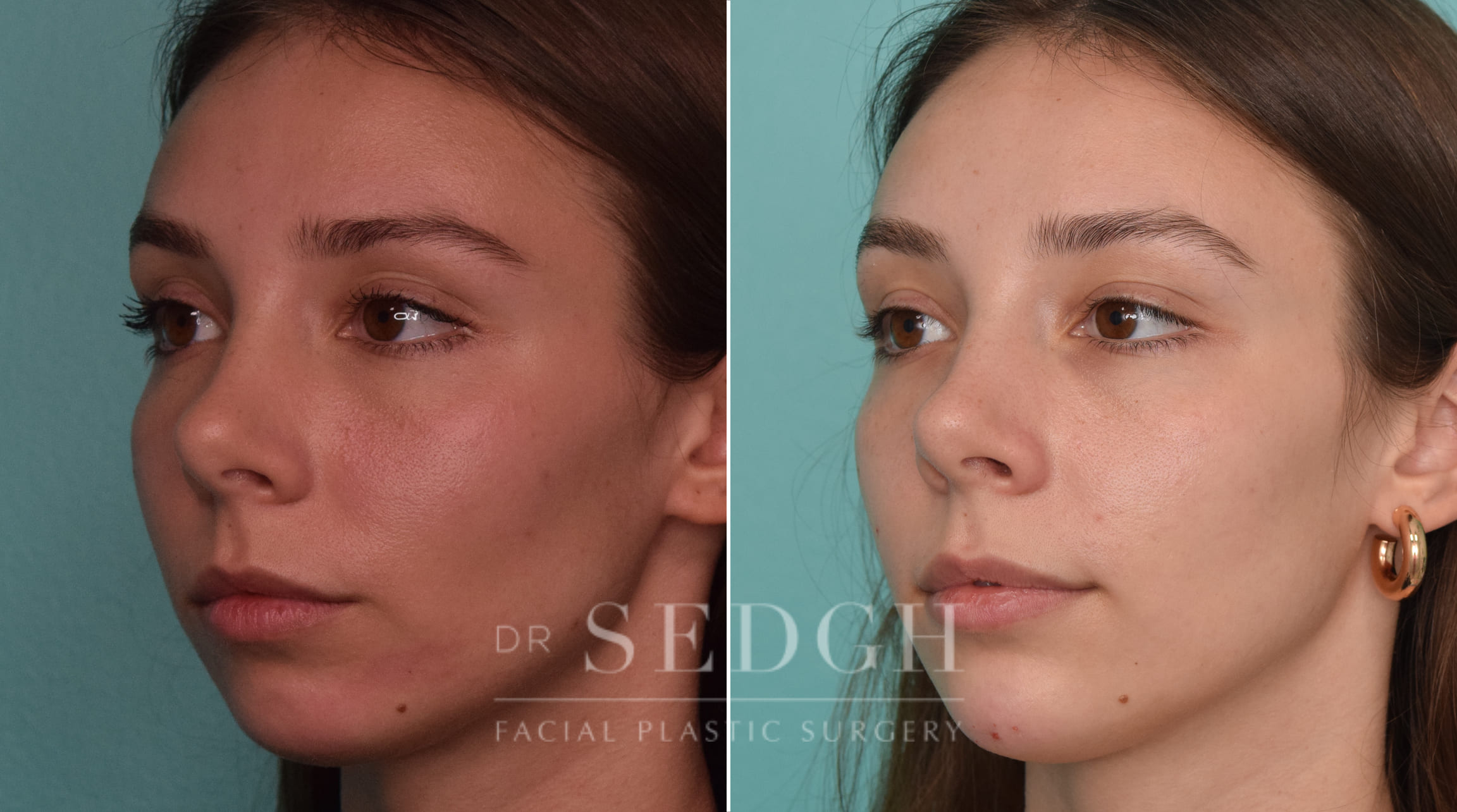 Patient Before and After Chin Filler | Sedgh