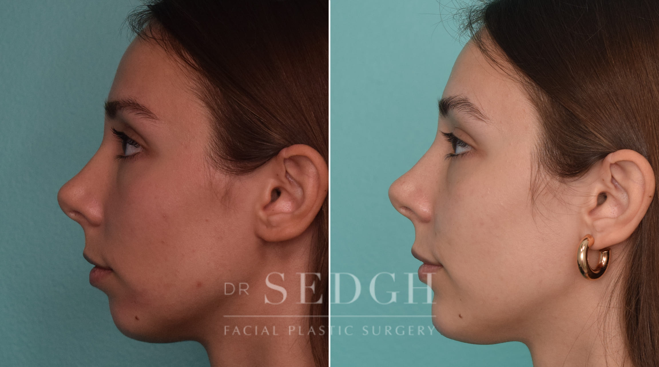 Patient Before and After Chin Filler | Sedgh