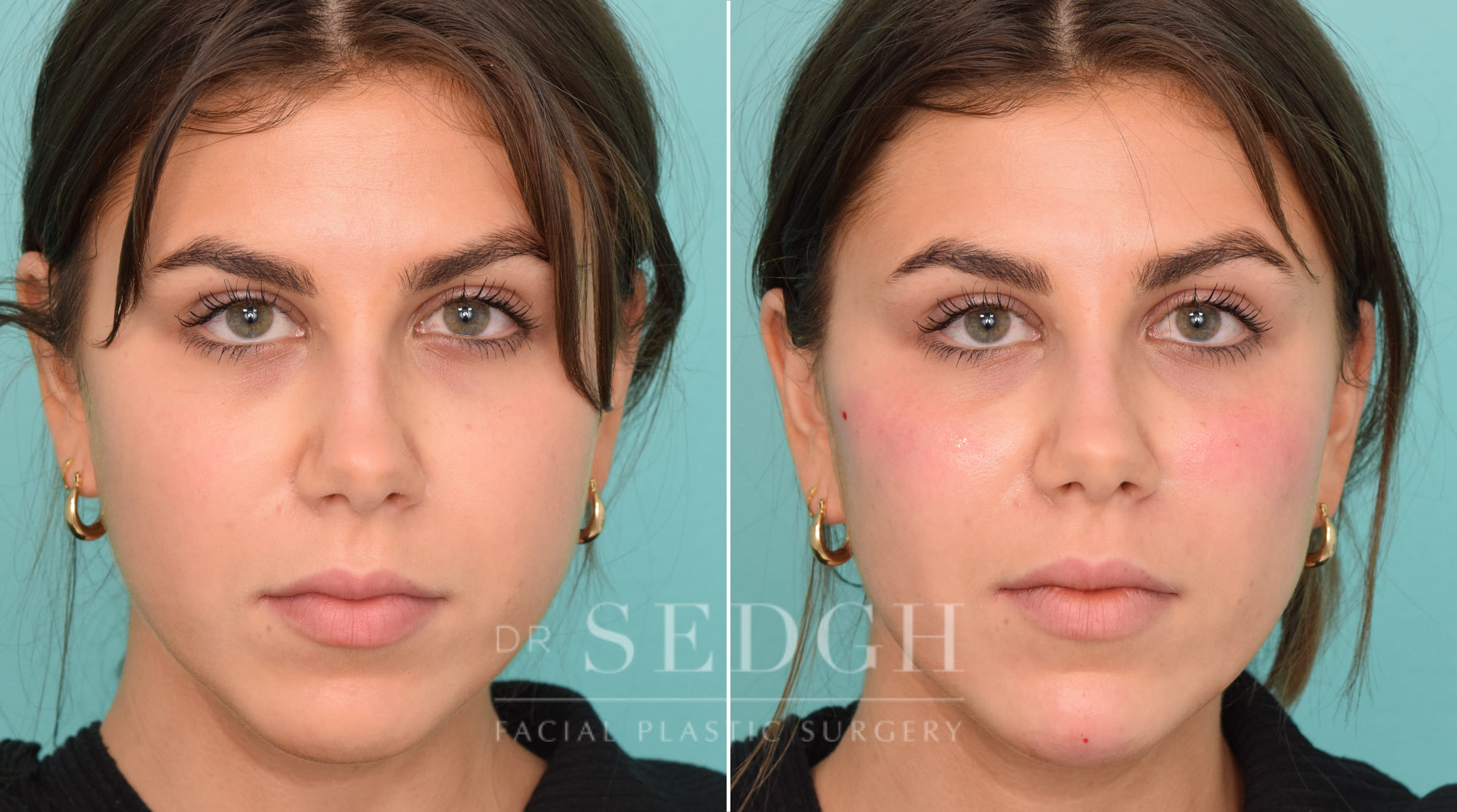 Patient Before and After Chin Filler | Sedgh