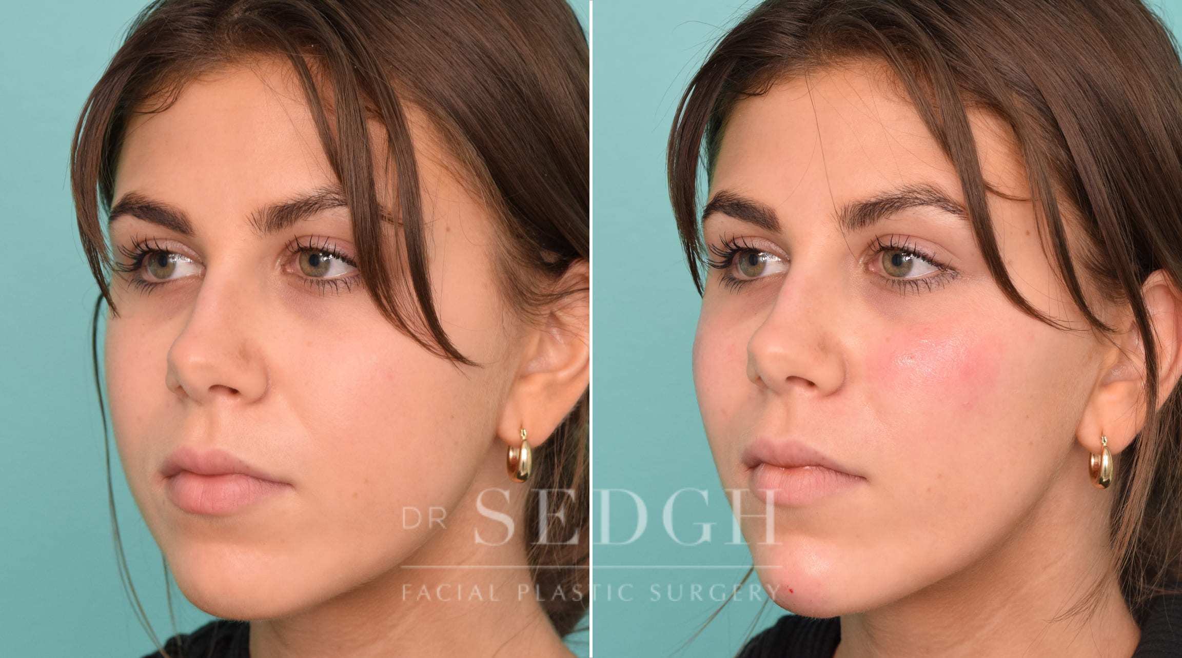 Patient Before and After Chin Filler | Sedgh