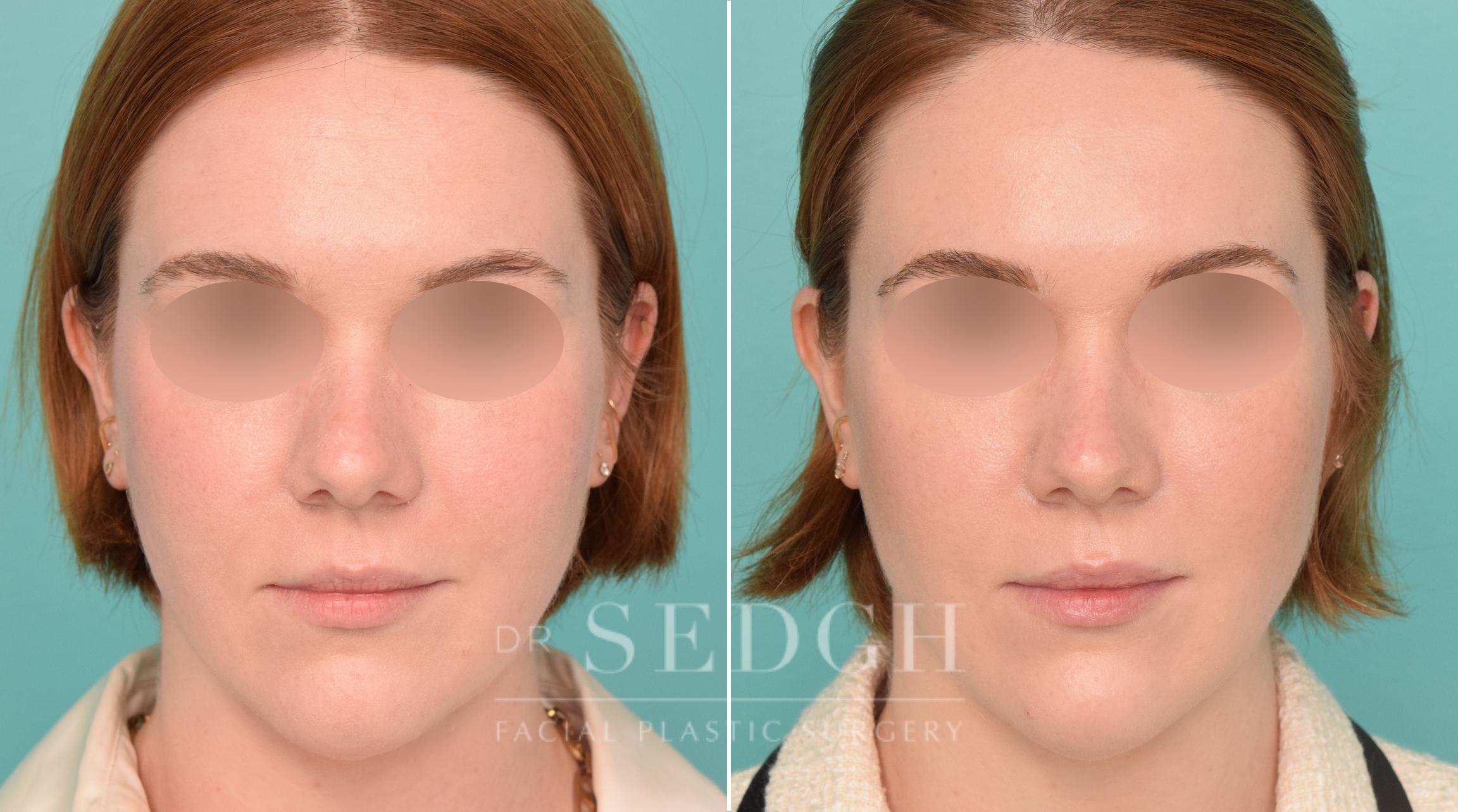 Patient Before and After Jawline Filler | Sedgh