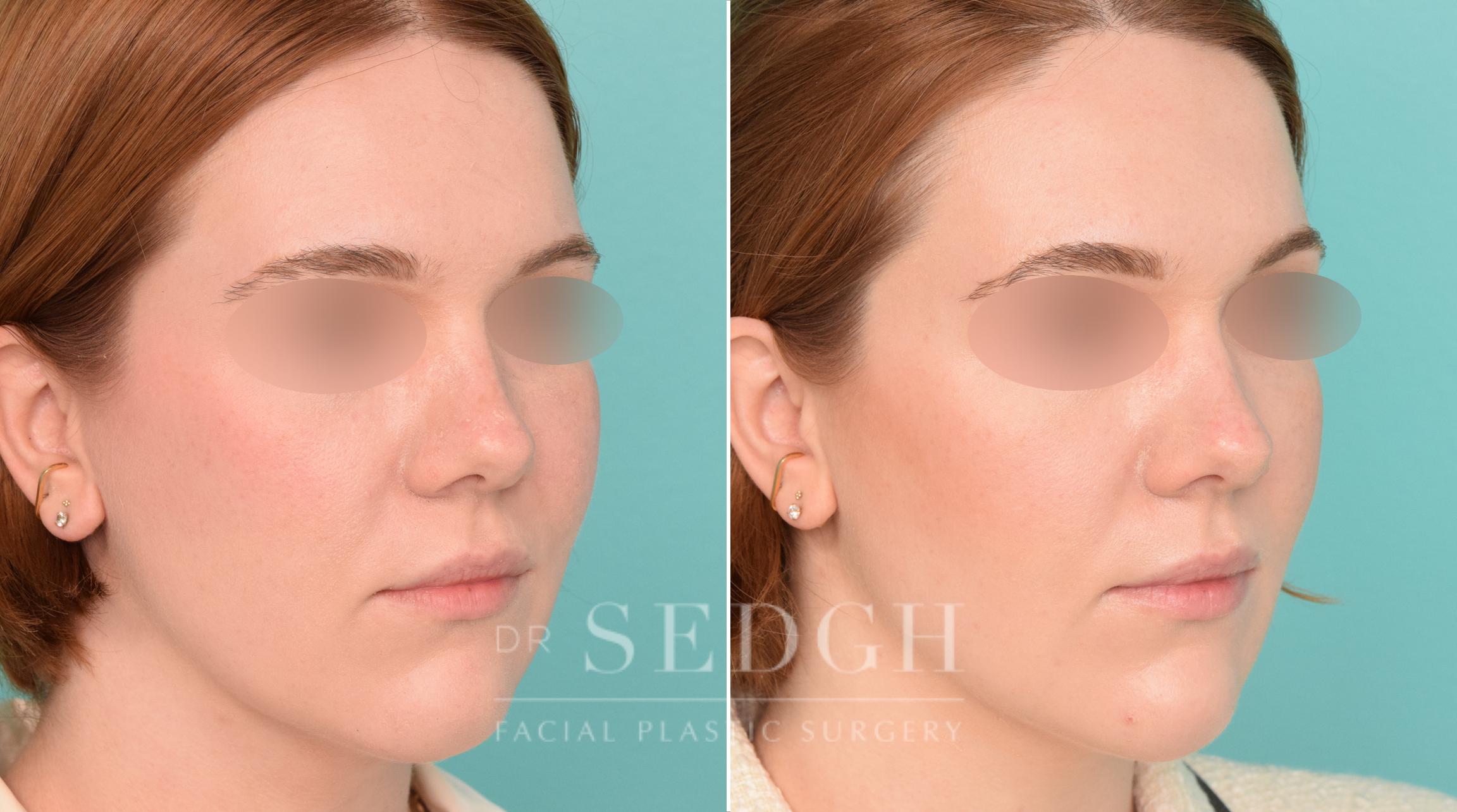 Patient Before and After Jawline Filler | Sedgh