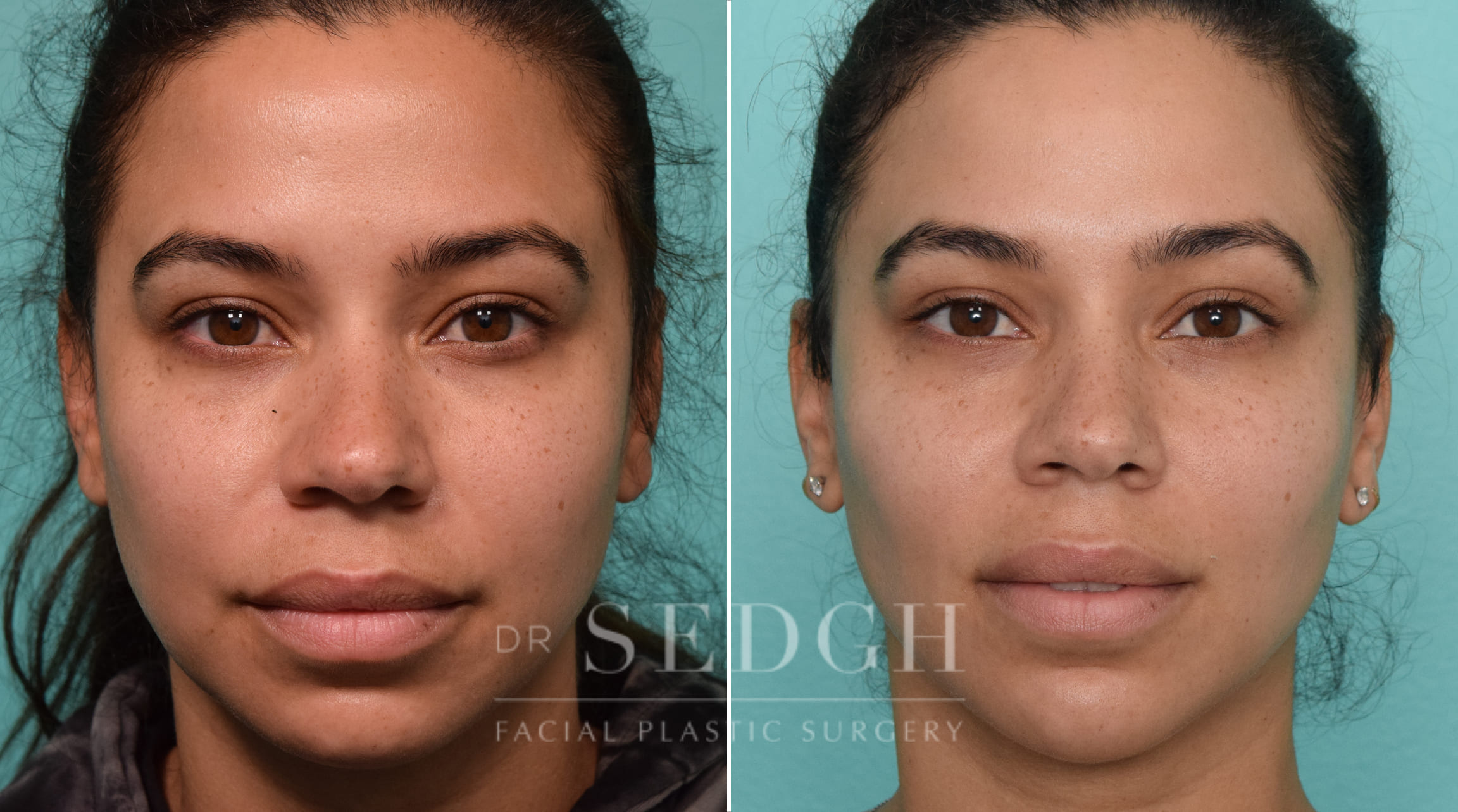 patient before and after buccal fat reduction and neck liposuction