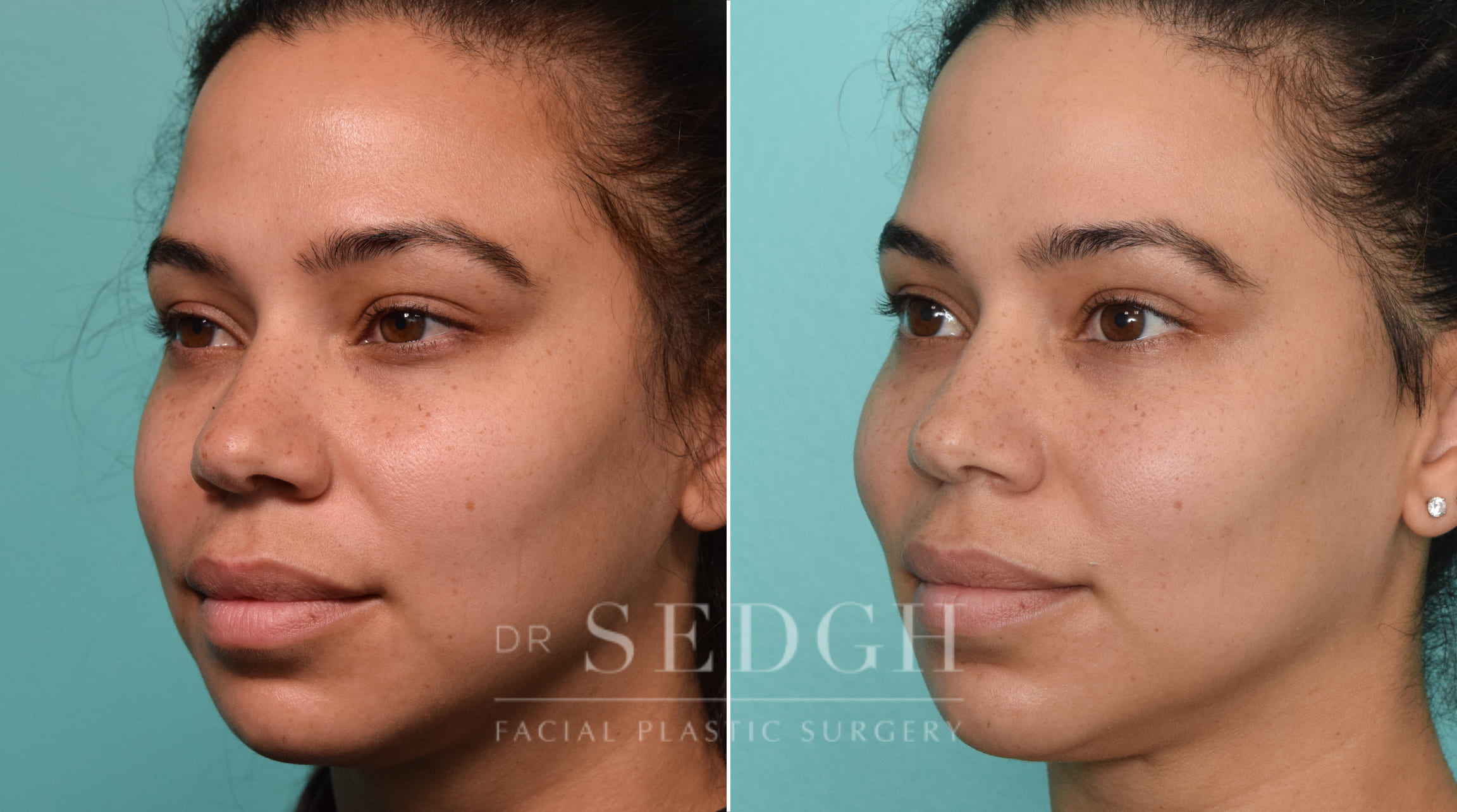 patient before and after buccal fat reduction and neck liposuction