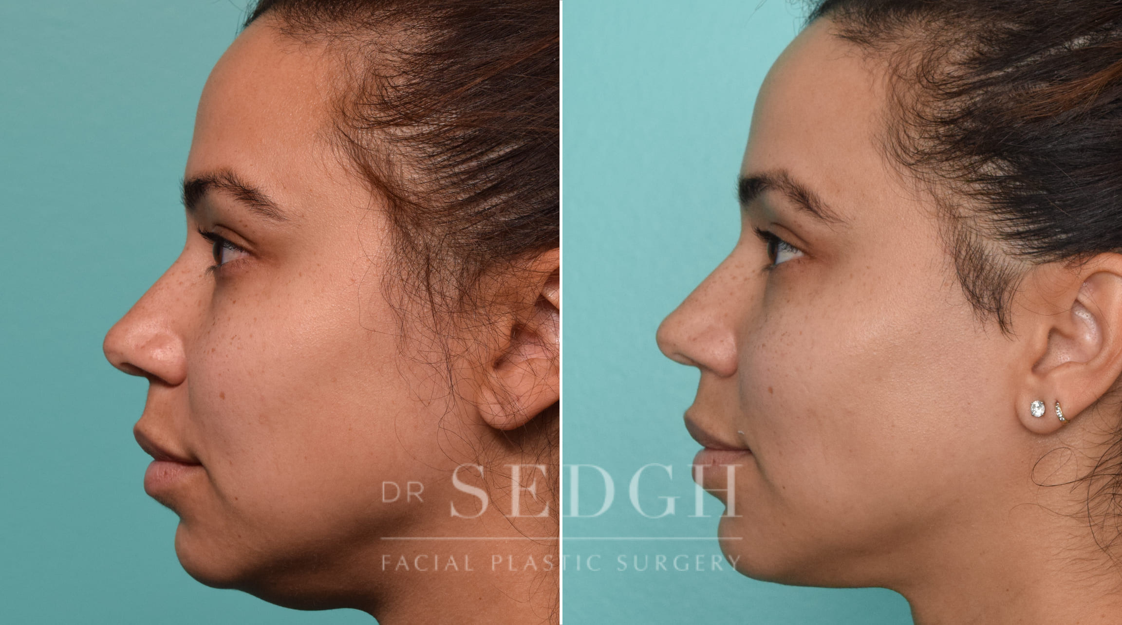 patient before and after buccal fat reduction and neck liposuction