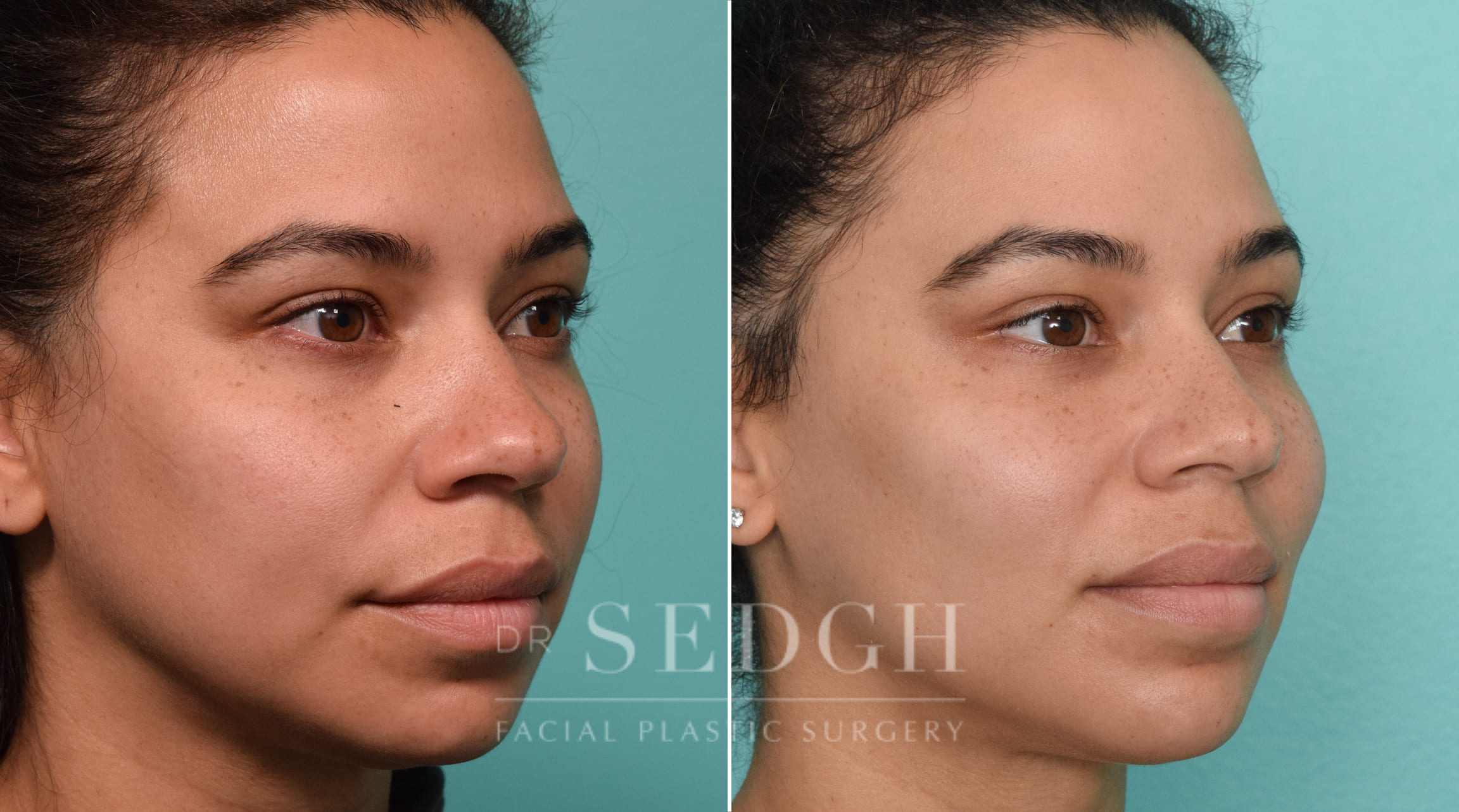 patient before and after buccal fat reduction and neck liposuction