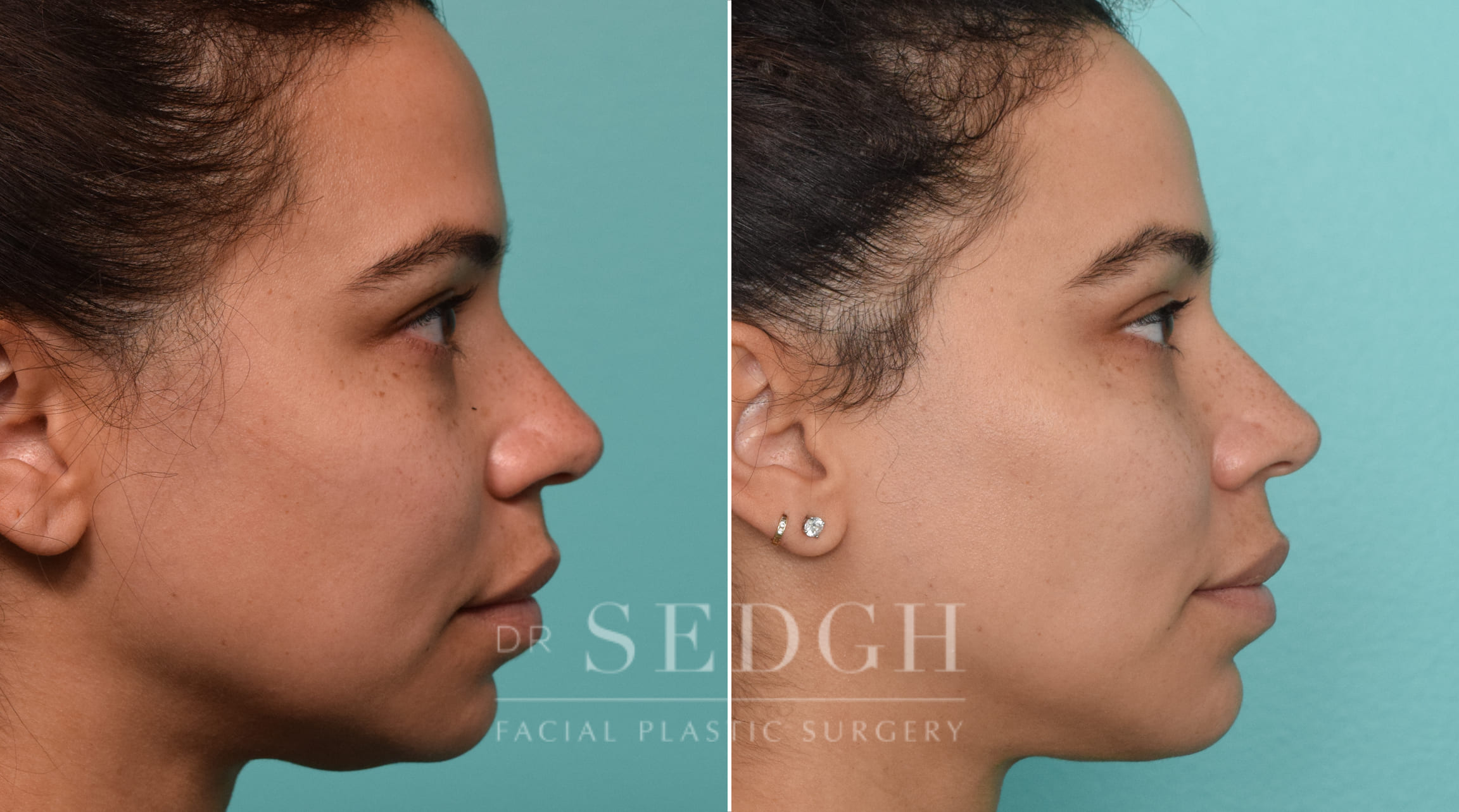 patient before and after buccal fat reduction and neck liposuction