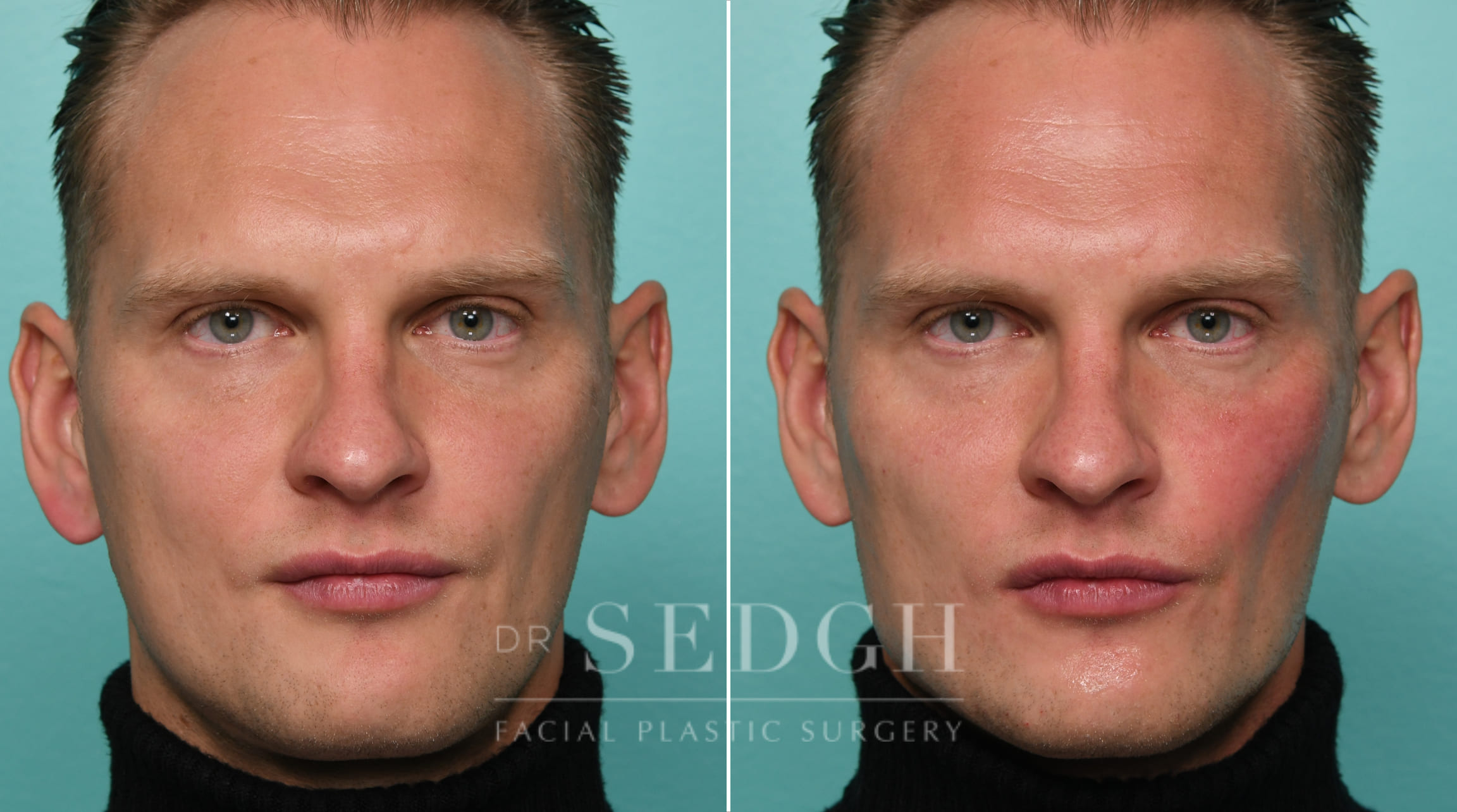 Male Patient Before and After Chin and Jawline Filler | Sedgh