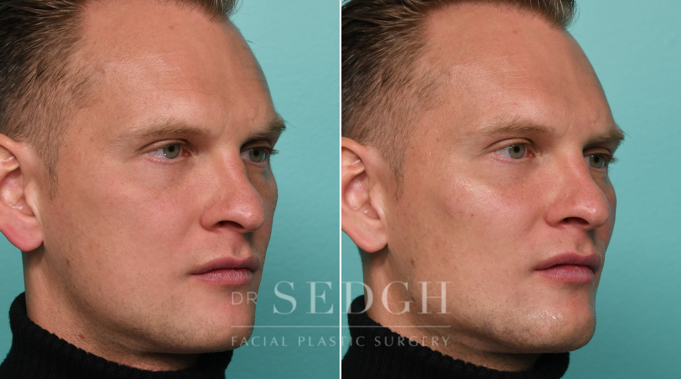 Male Patient Before and After Chin and Jawline Filler | Sedgh