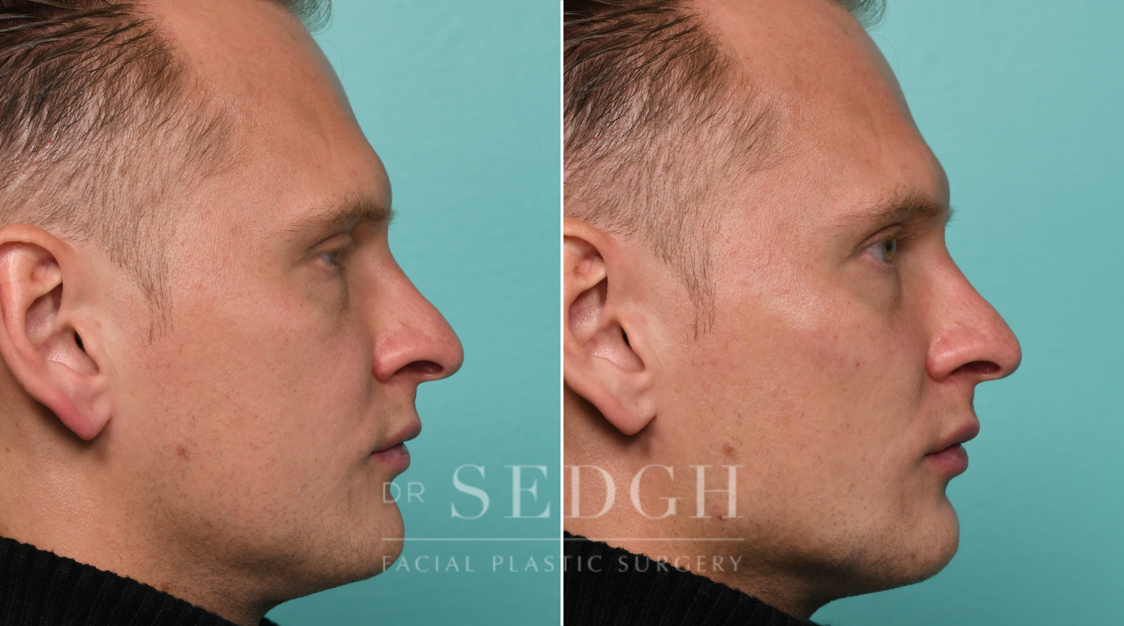 Male Patient Before and After Chin and Jawline Filler | Sedgh