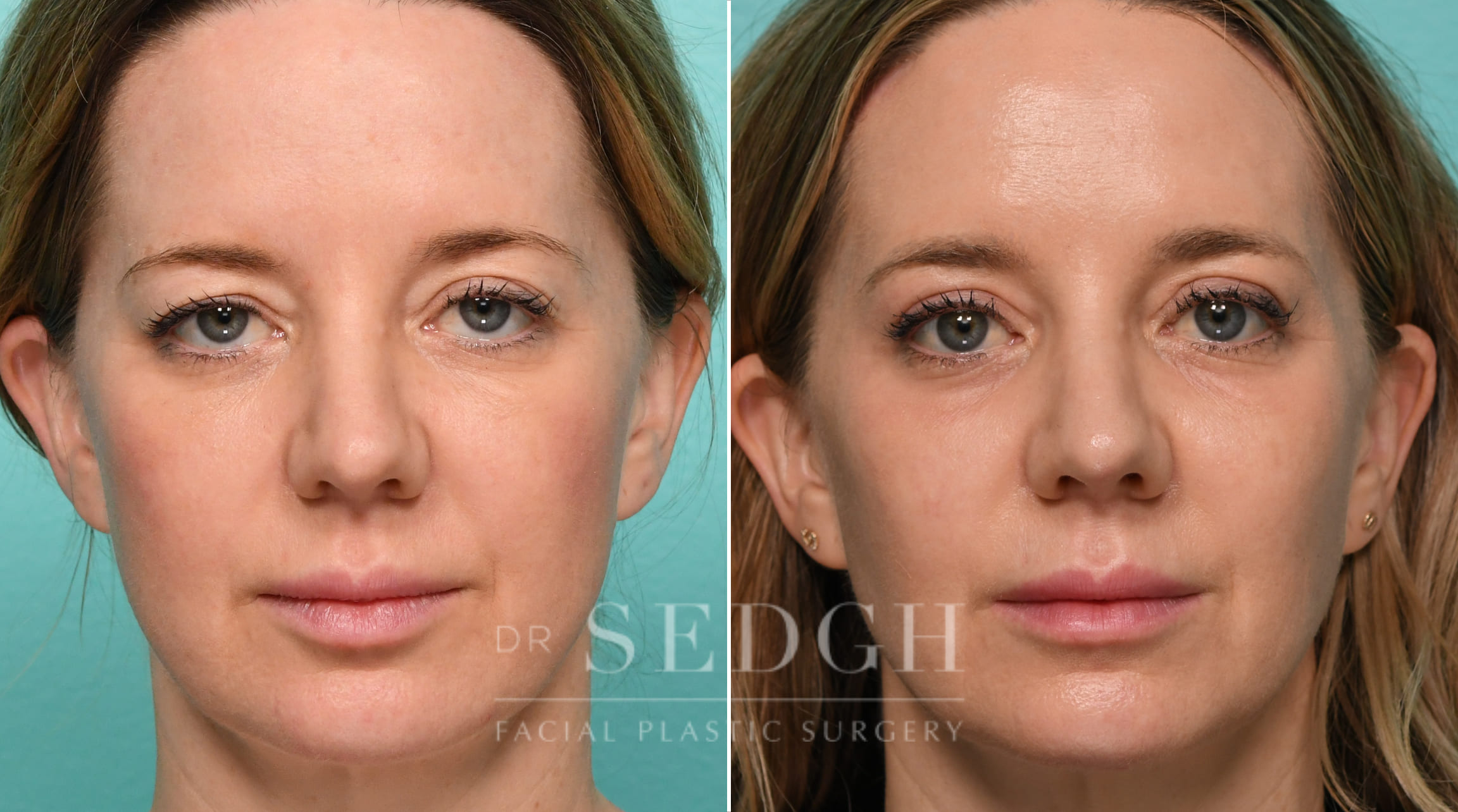 patient before and after brow lift and buccal fat reduction procedure