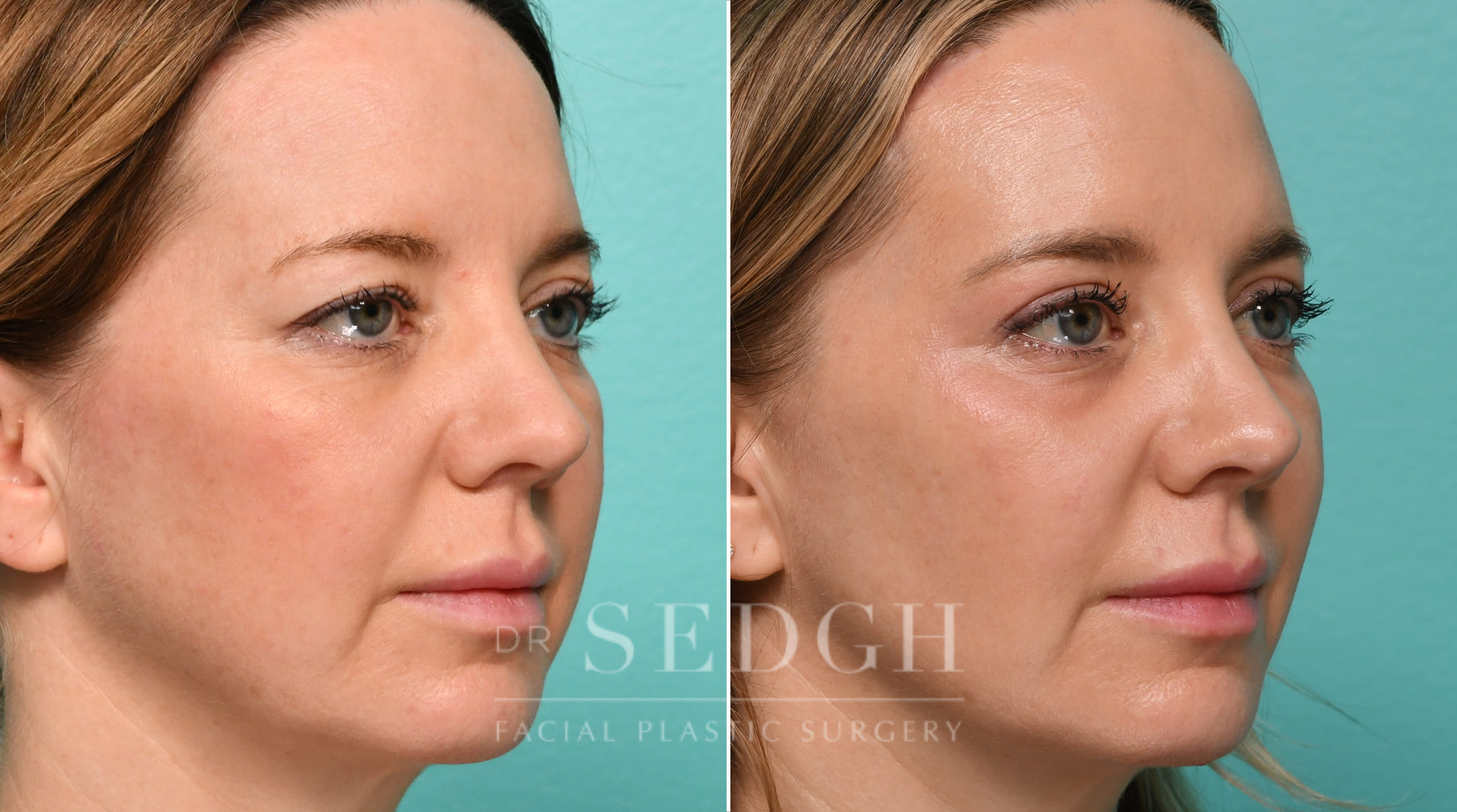 patient before and after brow lift and buccal fat reduction procedure