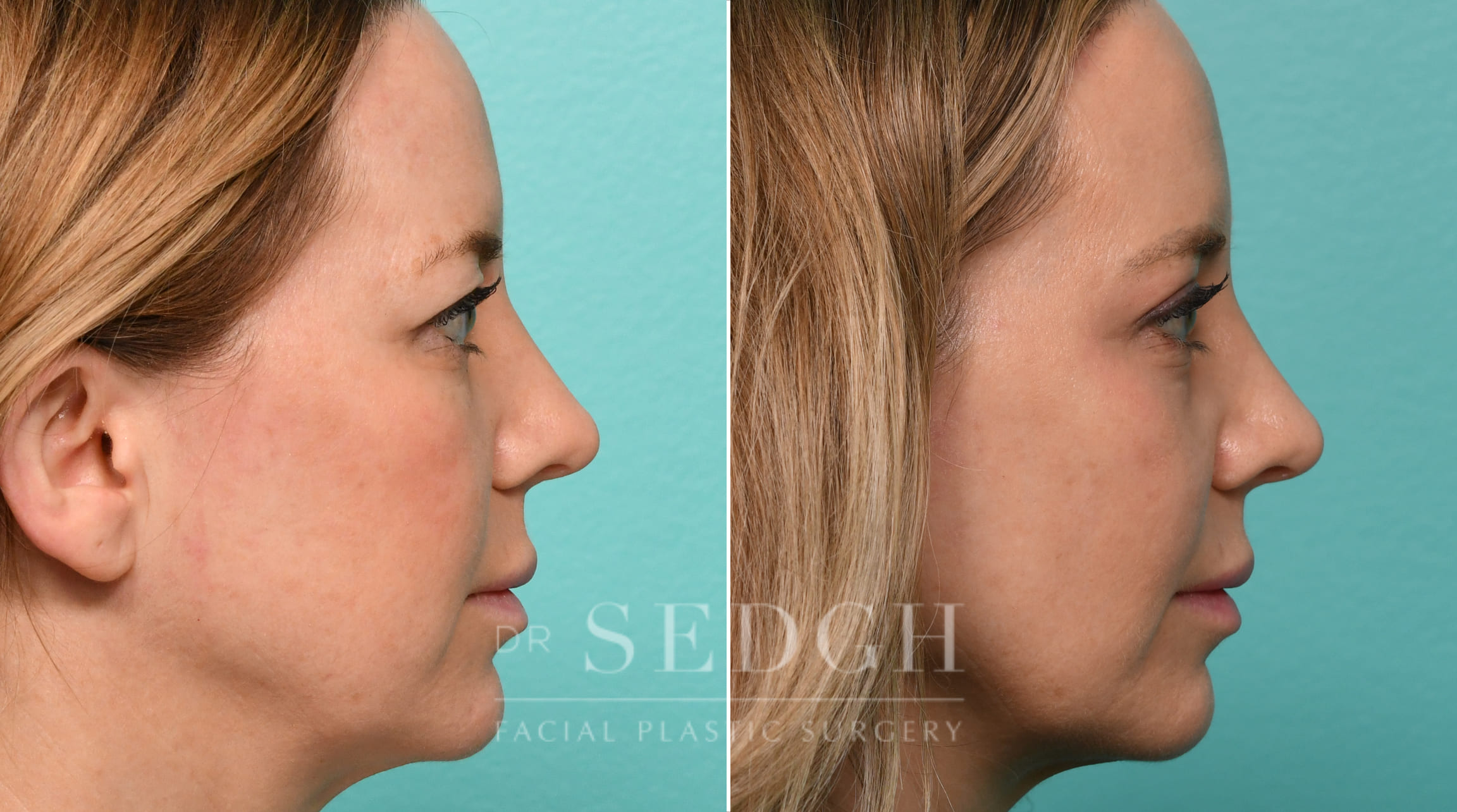 patient before and after brow lift and buccal fat reduction procedure